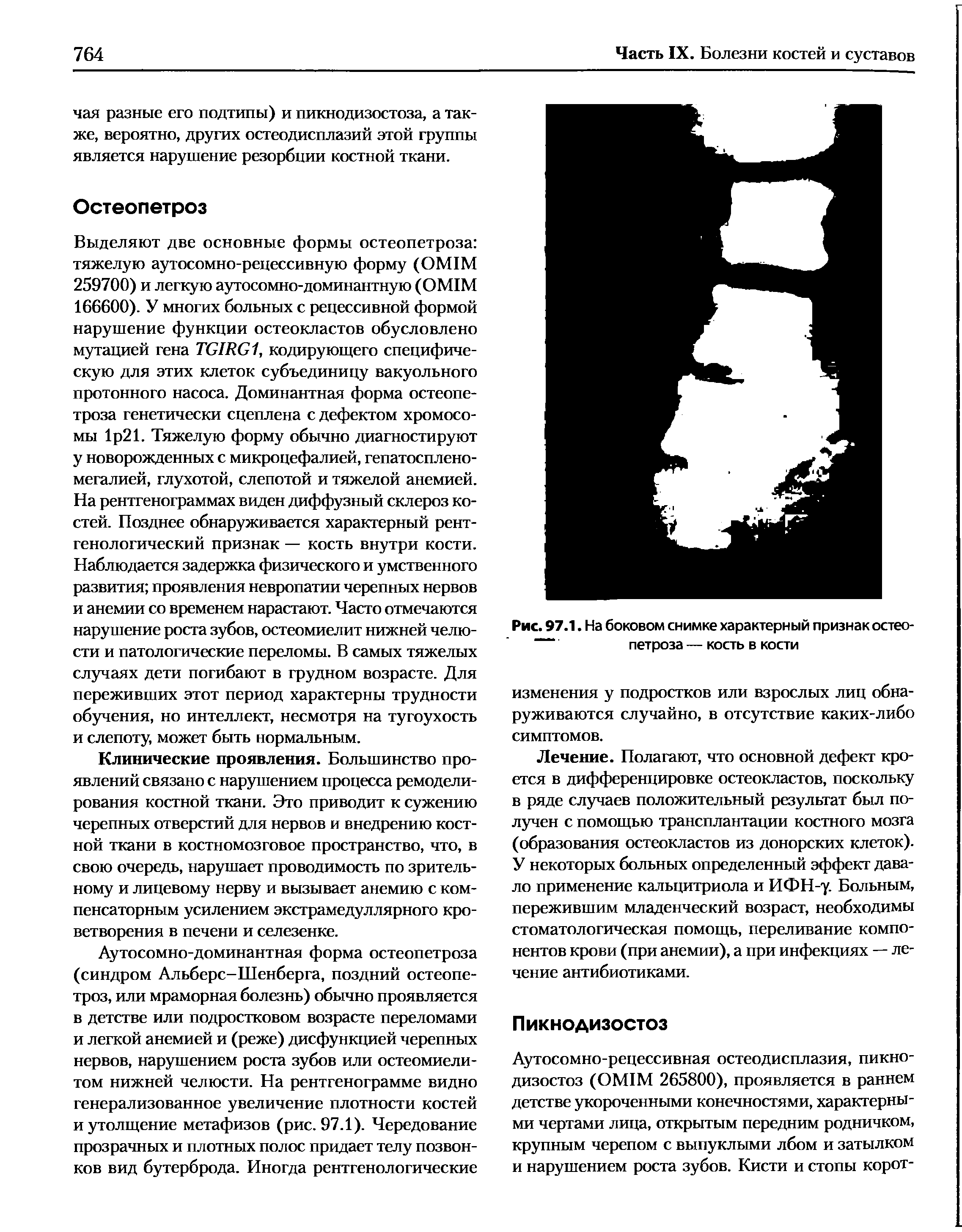 Рис. 97.1. На боковом снимке характерный признак остео-петроза — кость в кости...