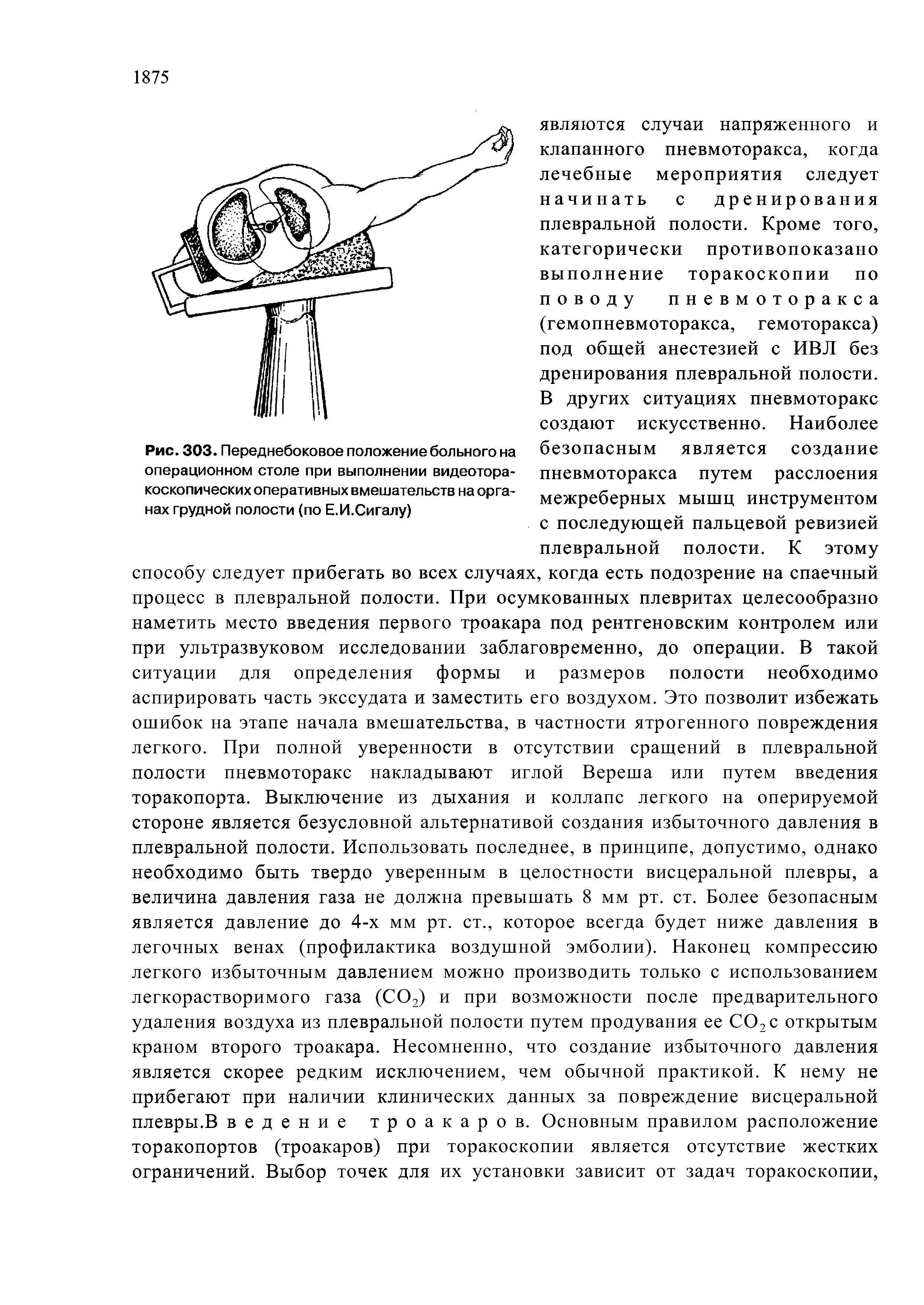 Рис. 303. Переднебоковое положение больного на операционном столе при выполнении видеотора-коскопических оперативных вмешательств на органах грудной полости (по Е.И.Сигалу)...