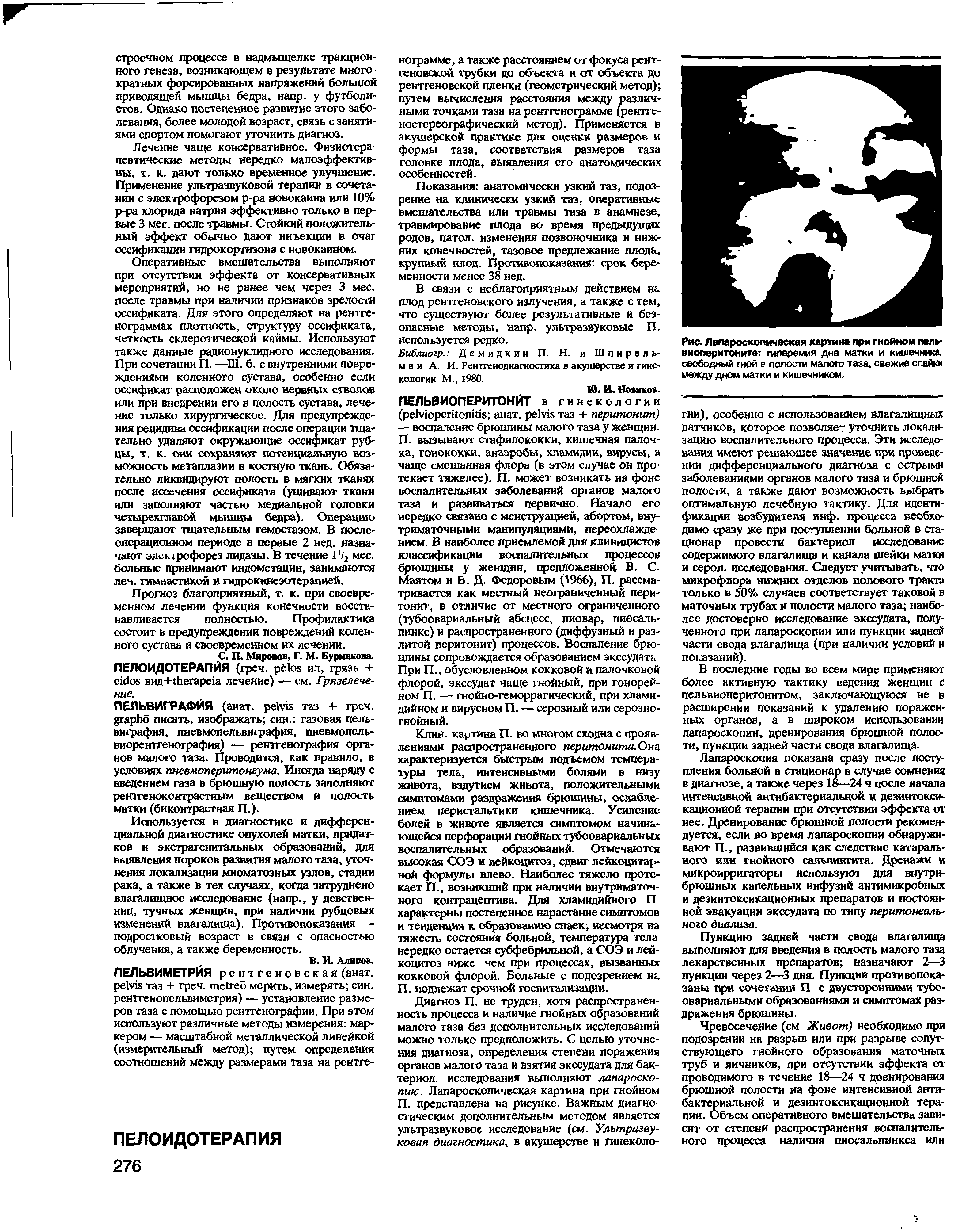 Рис. Лапароскопическая картина при гнойном паль-виоперитоните гиперемия дна матки и кишечника, свободный гной е полости малого таза, свежие спайки между дном матки и кишечником.