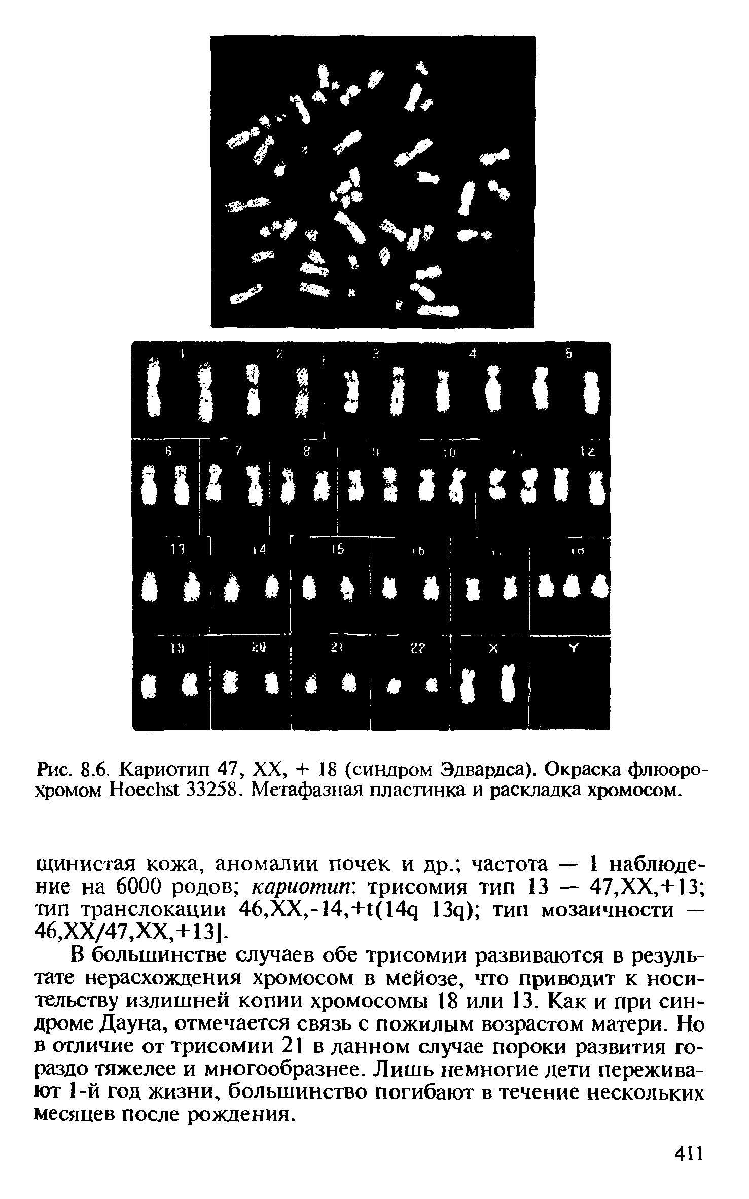 Рис. 8.6. Кариотип 47, XX, + 18 (синдром Эдвардса). Окраска флюорохромом H 33258. Метафазная пластинка и раскладка хромосом.