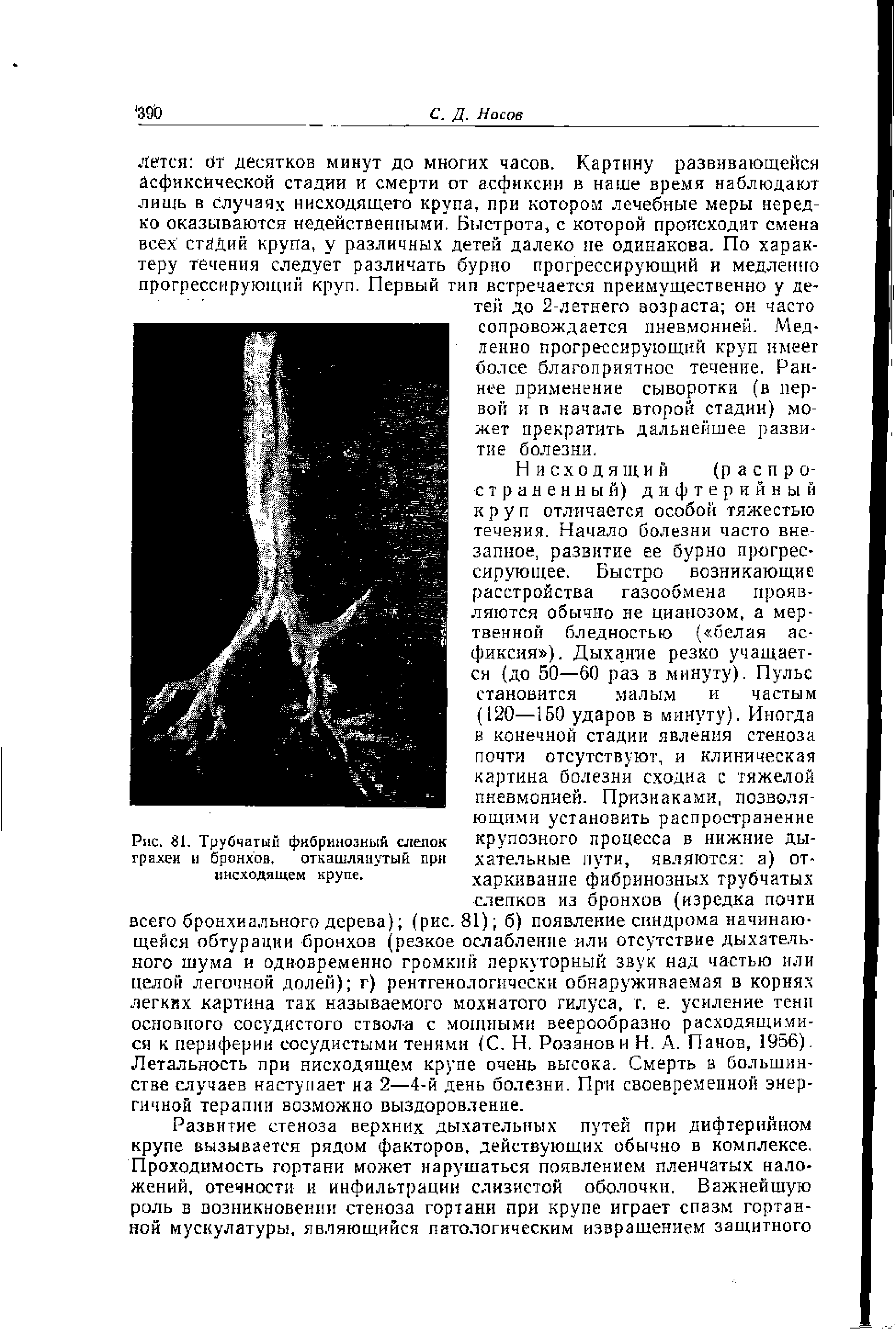 Рис. 81. Трубчатый фибринозный слепок крупозного процесса в нижние ды-грахеи н бронхов, откашлянутый при хательные пути, являются а) ОТ-ннсходящем крупе. харкивание фибринозных трубчатых...