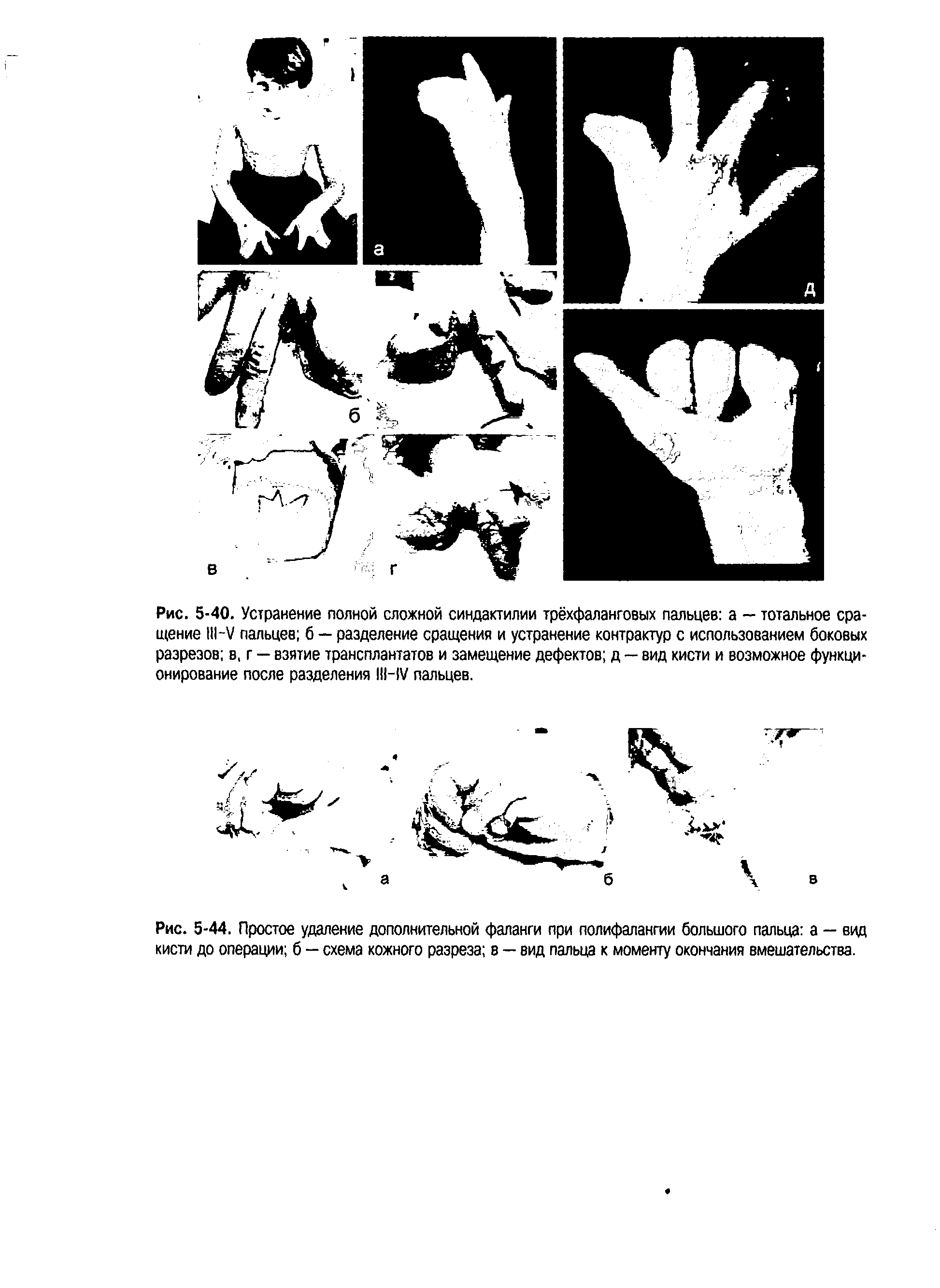 Рис. 5-44. Простое удаление дополнительной фаланги при полифалангии большого пальца а — вид кисти до операции б — схема кожного разреза в — вид пальца к моменту окончания вмешательства.