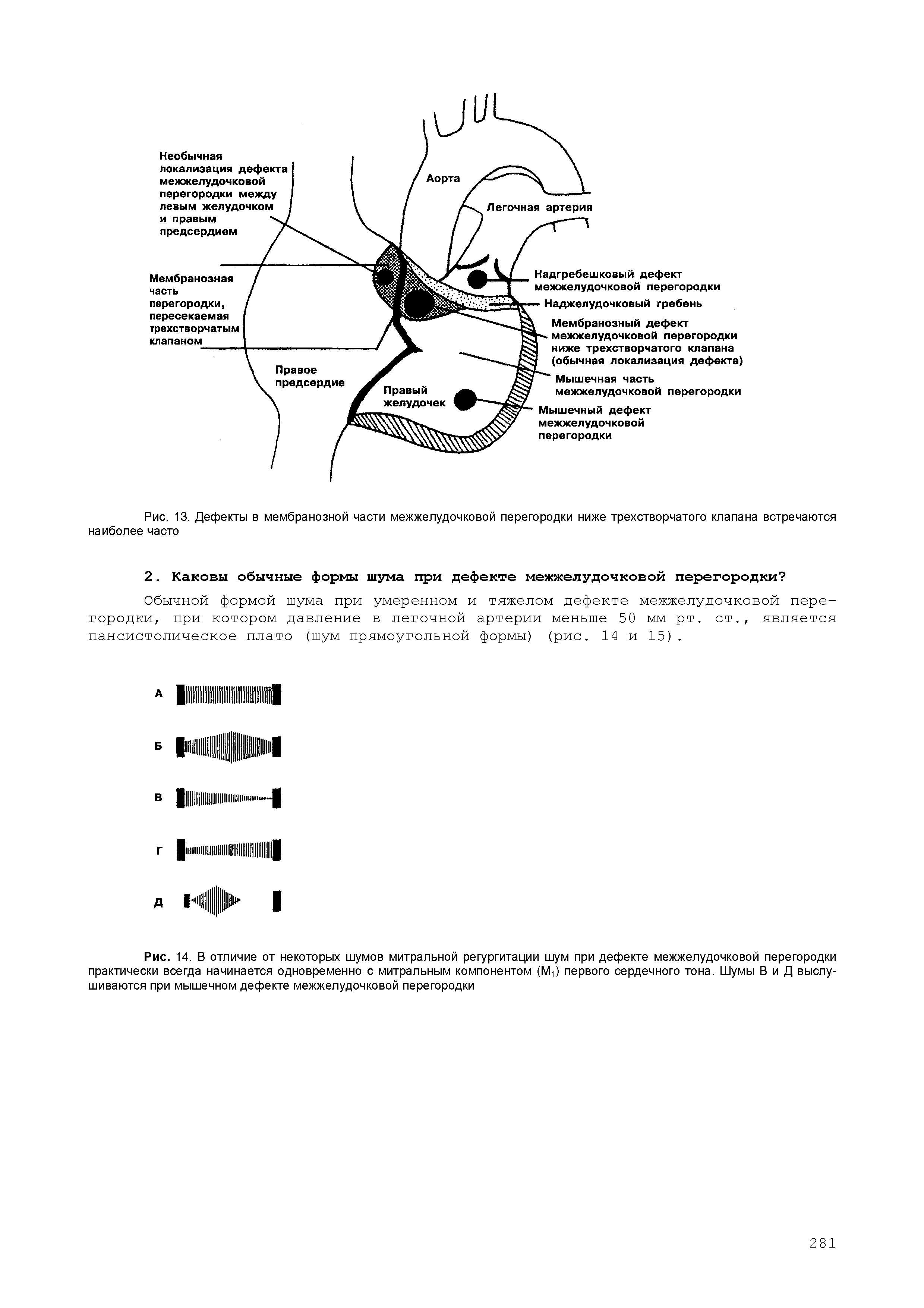Рис. 14. В отличие от некоторых шумов митральной регургитации шум при дефекте межжелудочковой перегородки практически всегда начинается одновременно с митральным компонентом (М,) первого сердечного тона. Шумы В и Д выслушиваются при мышечном дефекте межжелудочковой перегородки...