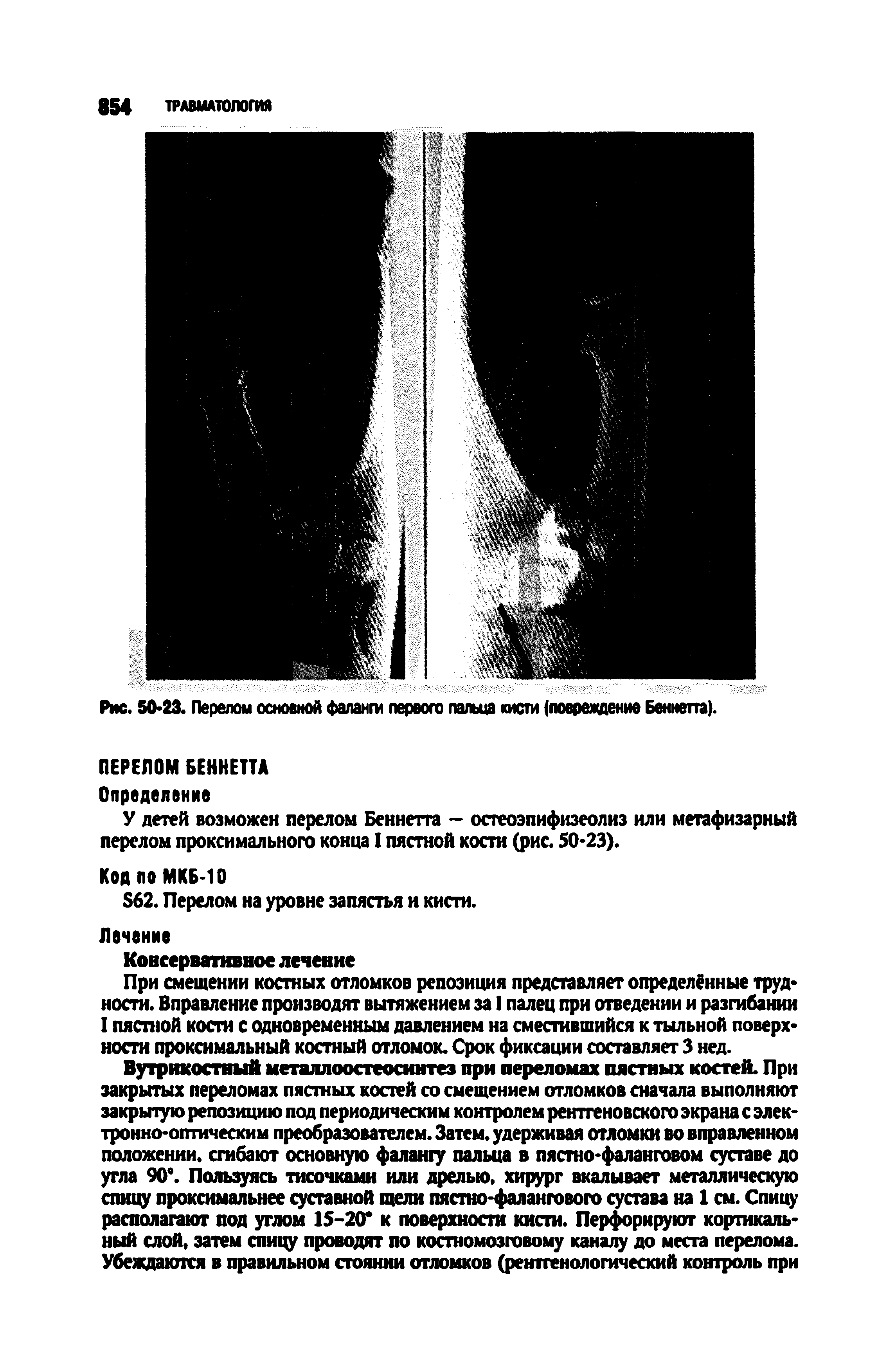 Рис. 50 23. Перелом основной фаланги первого пальца кисти (повреждение Беннетта).