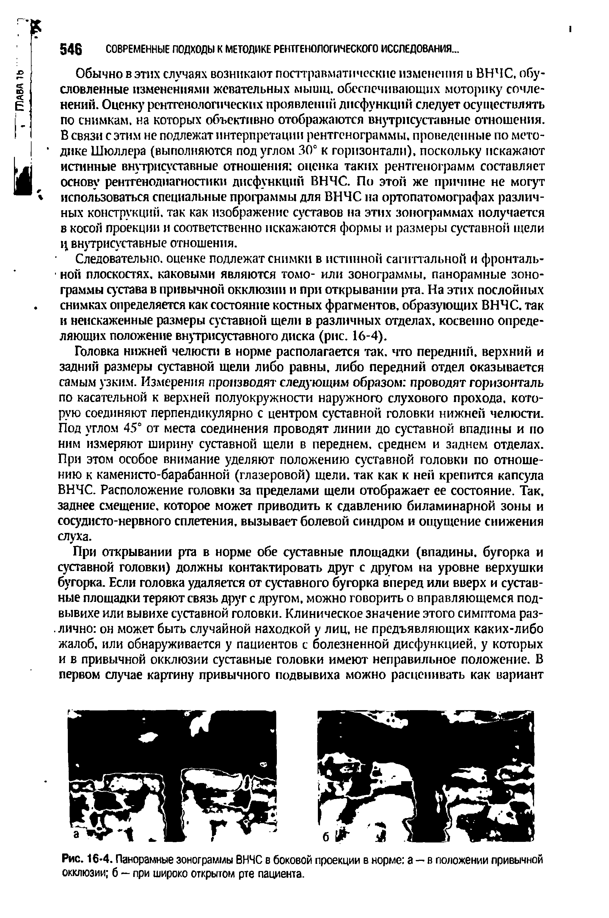 Рис. 16-4. Панорамные зонограммы ВНЧС в боковой проекции в норме а — в положении привычной окклюзии б — при широко открытом рте пациента.