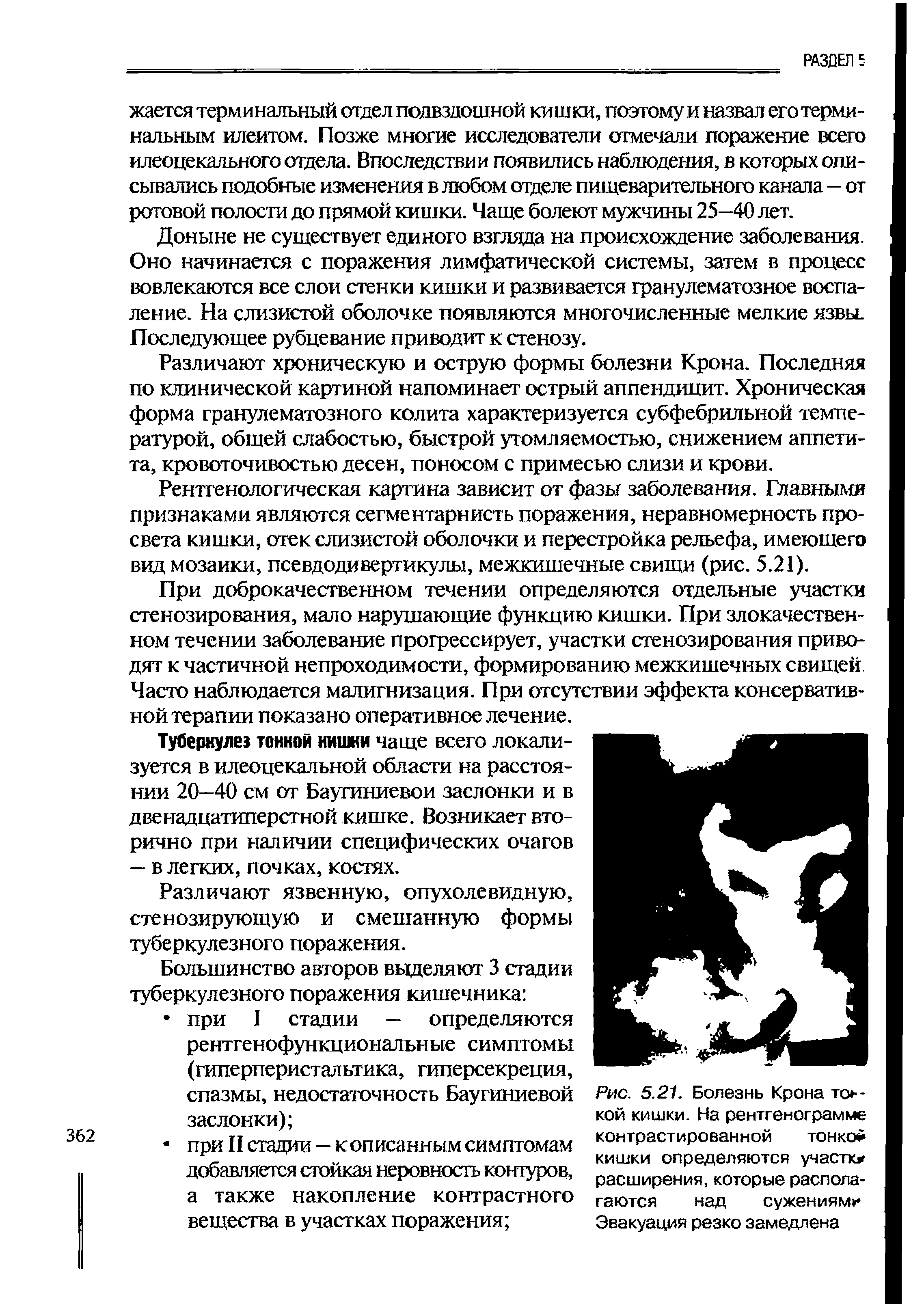 Рис. 5.21. Болезнь Крона тонкой кишки. На рентгенограмме контрастированной тонко кишки определяются участкж расширения, которые располагаются над сужениям Эвакуация резко замедлена...