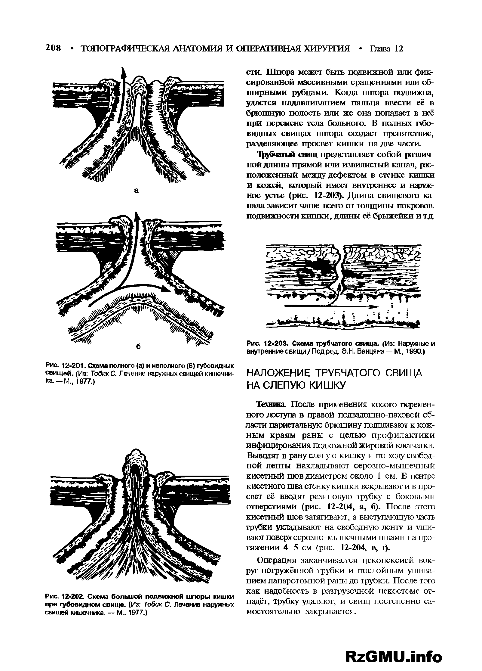 Рис. 12-201. Схема полного (а) и неполного (6) губовидных, свищей. (Из ТобикС. Лечение наружных свищей кишечника. -М 1977.)...