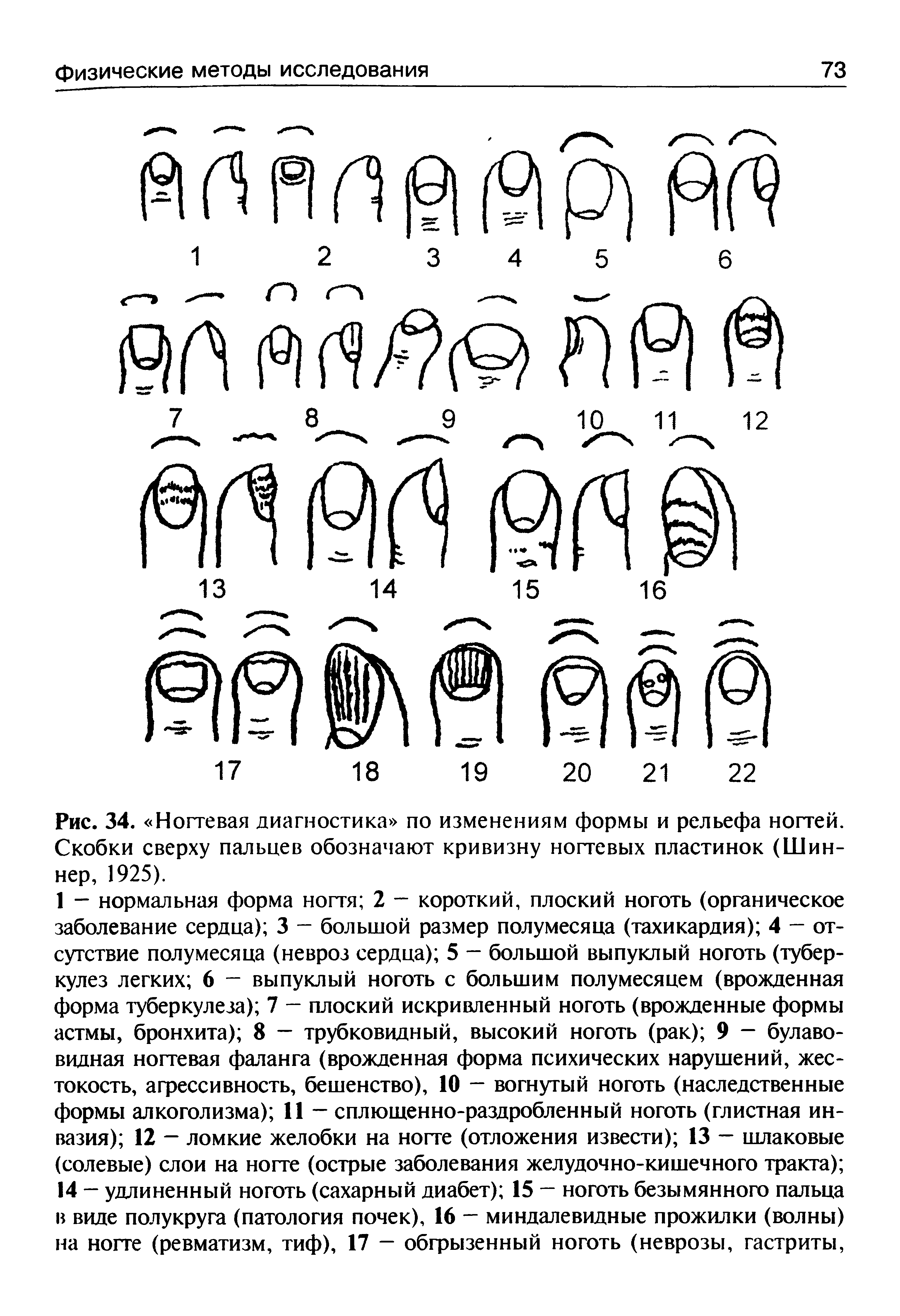 Рис. 34. Ногтевая диагностика по изменениям формы и рельефа ногтей. Скобки сверху пальцев обозначают кривизну ногтевых пластинок (Шиннер, 1925).