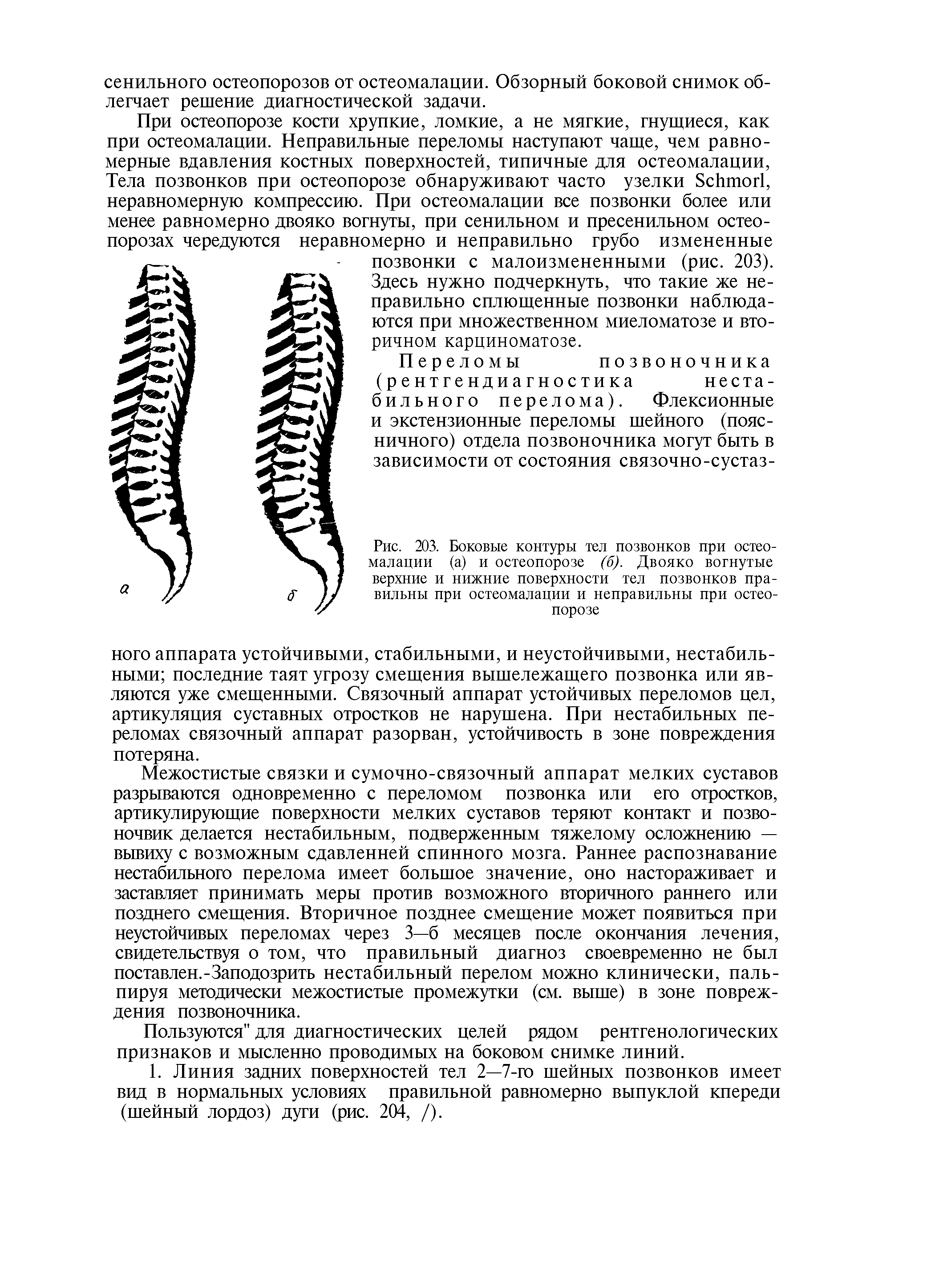 Рис. 203. Боковые контуры тел позвонков при остеомалации (а) и остеопорозе (б). Двояко вогнутые верхние и нижние поверхности тел позвонков правильны при остеомалации и неправильны при остеопорозе...