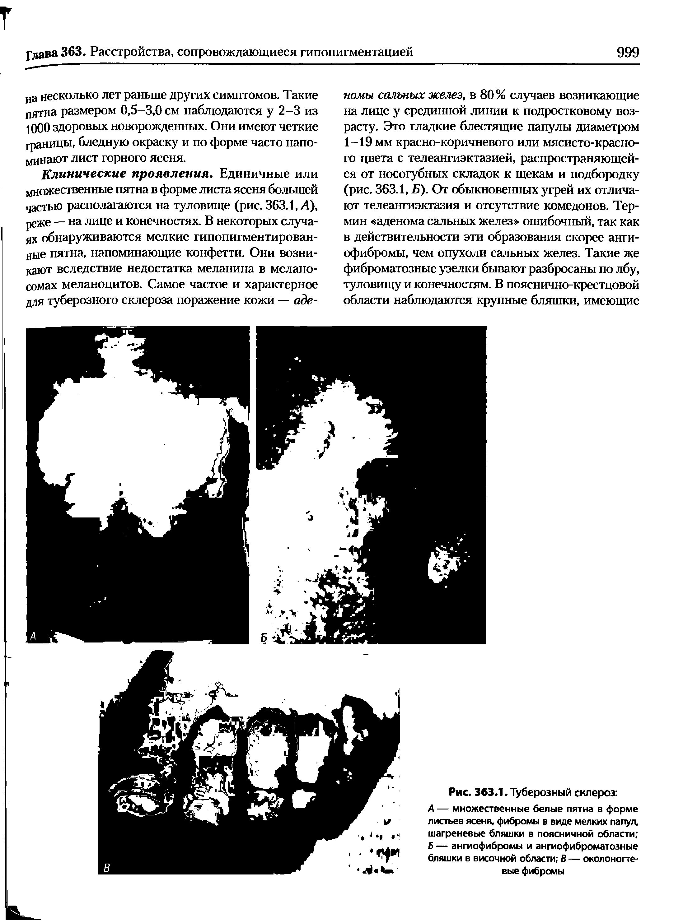 Рис. 363.1. Туберозный склероз А — множественные белые пятна в форме листьев ясеня, фибромы в виде мелких папул, шагреневые бляшки в поясничной области Б — ангиофибромы и ангиофиброматозные бляшки в височной области В— околоногте-вые фибромы...