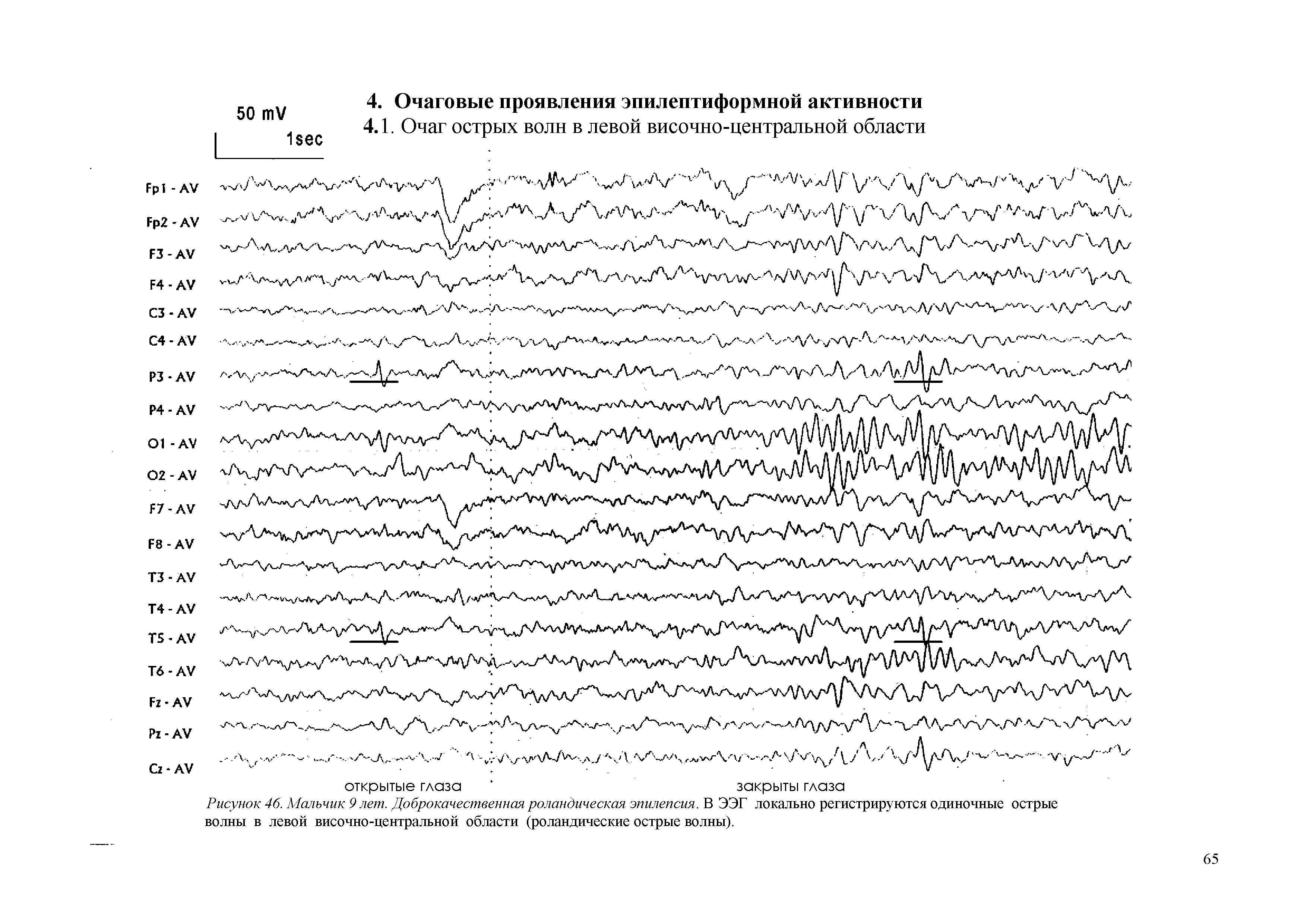 Рисунок 46. Мальчик 9 лет. Доброкачественная роландическая эпилепсия. В ЭЭГ локально регистрируются одиночные острые волны в левой височно-центральной области (роландические острые волны).