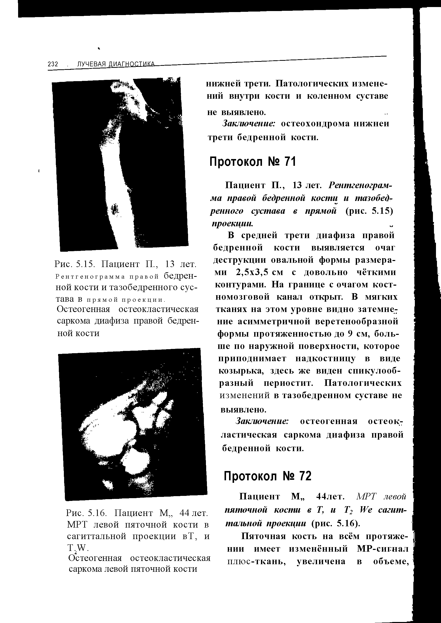 Рис. 5.16. Пациент М 44 лет. МРТ левой пяточной кости в сагиттальной проекции вТ, и T.W.