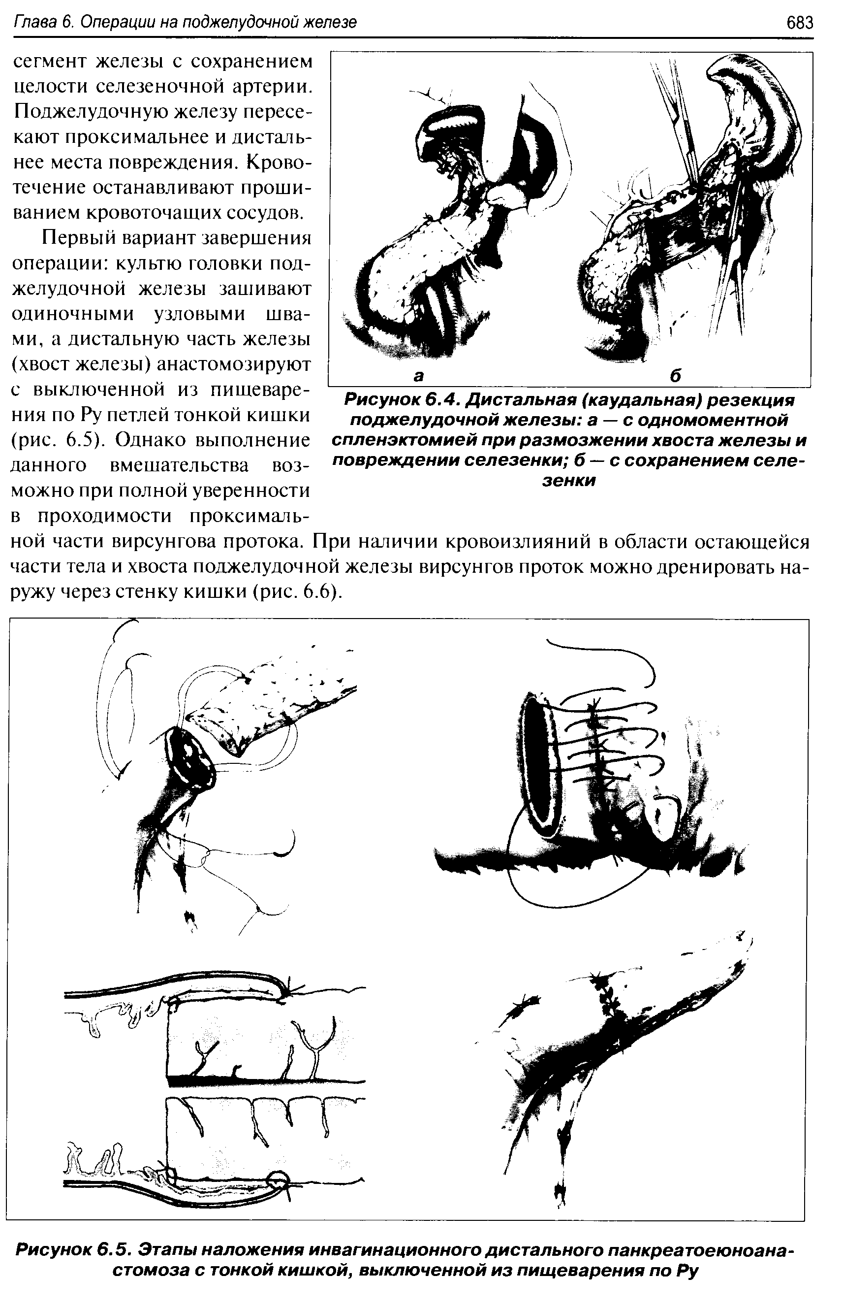 Рисунок 6.4. Дистальная (каудальная) резекция поджелудочной железы а —с одномоментной спленэктомией при размозжении хвоста железы и повреждении селезенки б — с сохранением селезенки...