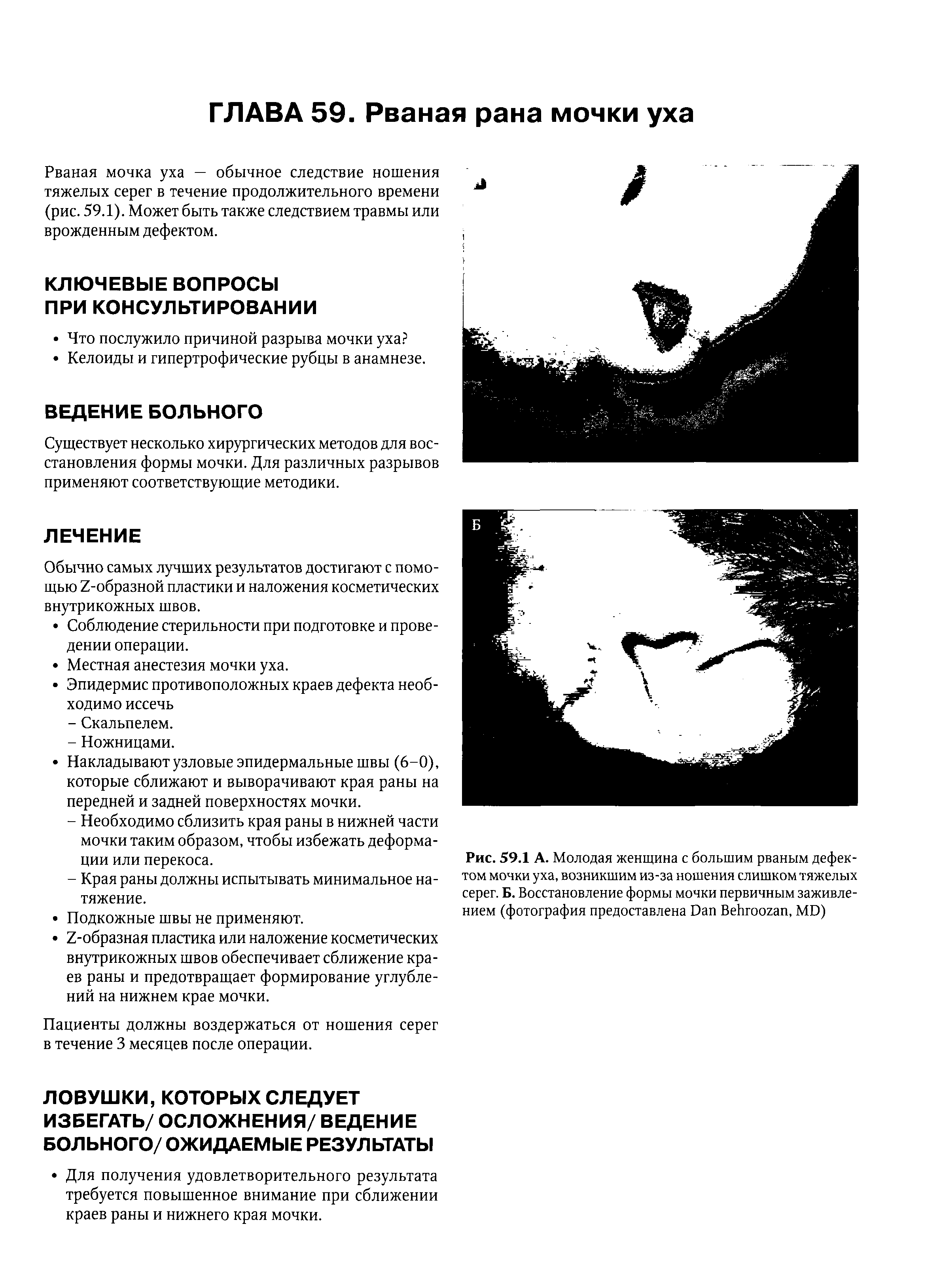 Рис. 59.1 А. Молодая женщина с большим рваным дефектом мочки уха, возникшим из-за ношения слишком тяжелых серег. Б. Восстановление формы мочки первичным заживлением (фотография предоставлена D B , MD)...