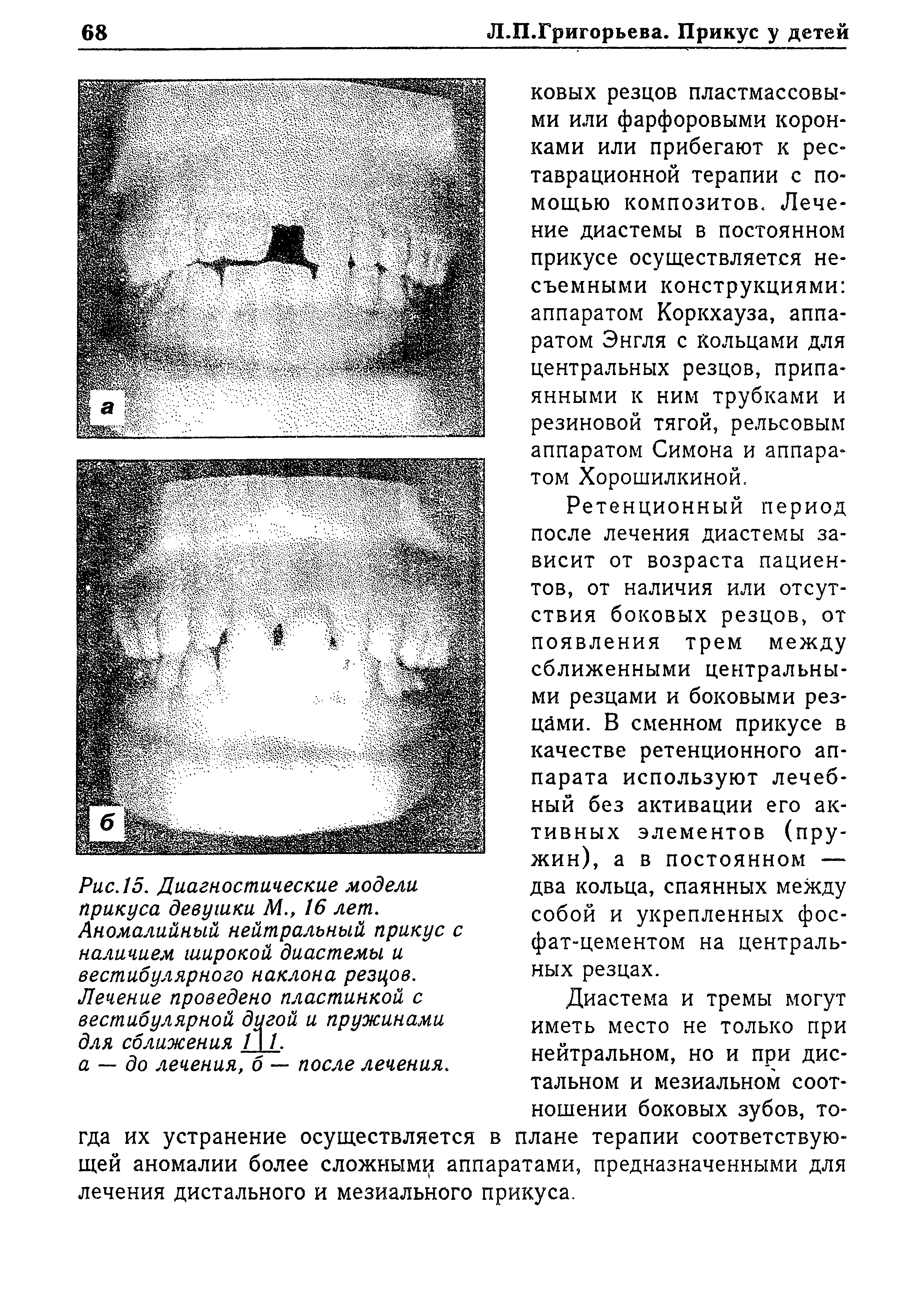 Рис. 15. Диагностические модели прикуса девушки М., 16 лет. Аномалийный нейтральный прикус с наличием широкой диастемы и вестибулярного наклона резцов. Лечение проведено пластинкой с вестибулярной дугой и пружинами для сближения /11.