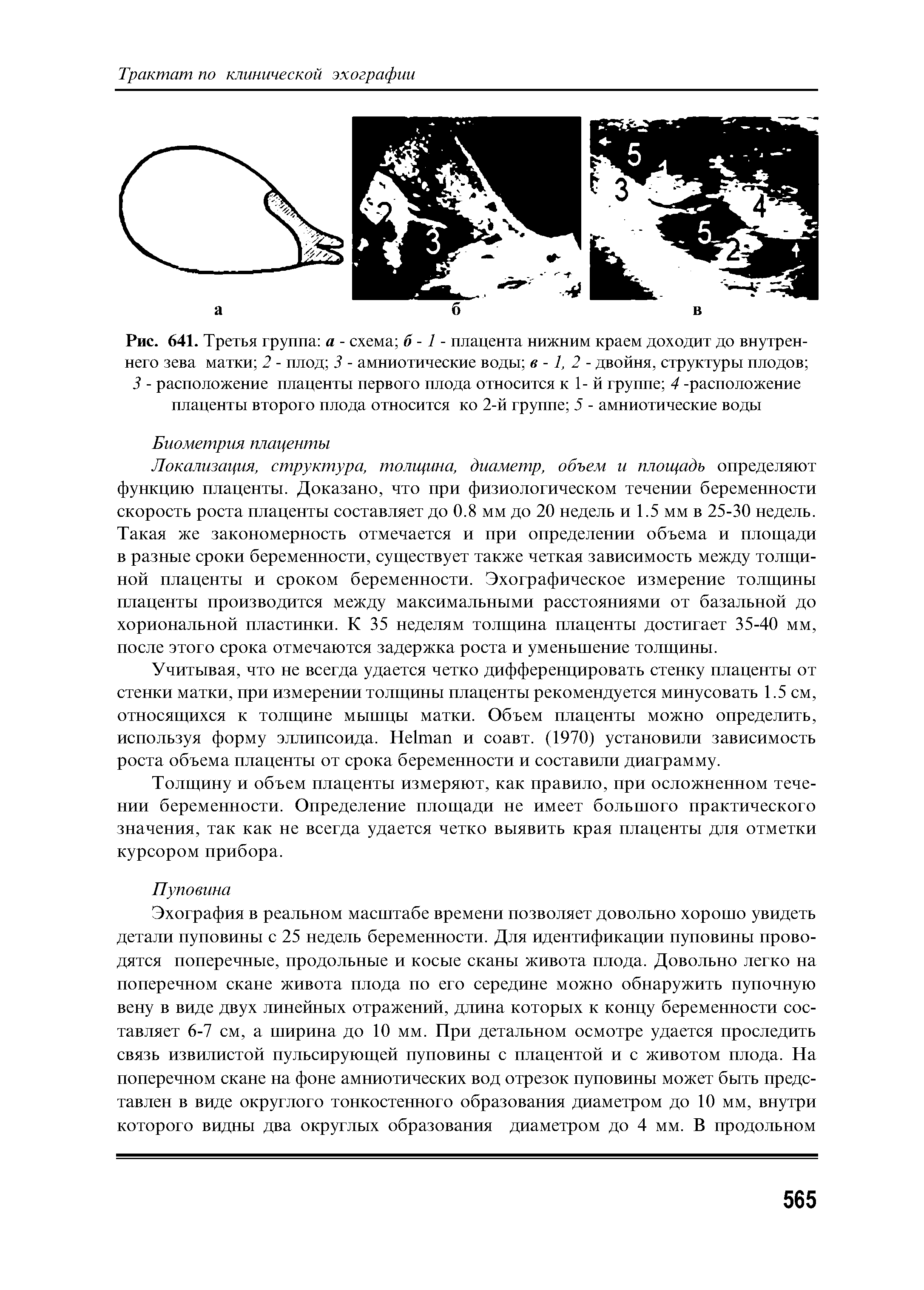 Рис. 641. Третья группа а - схема б -1 - плацента нижним краем доходит до внутреннего зева матки 2 - плод 3 - амниотические воды в -1, 2 - двойня, структуры плодов ...
