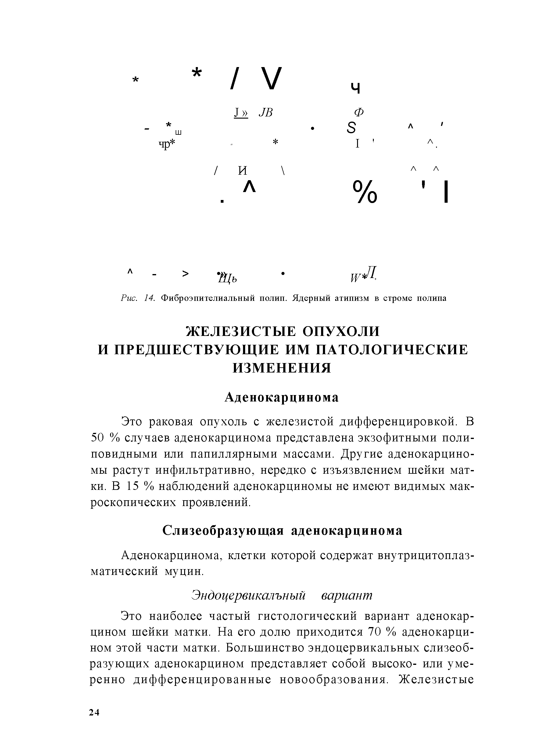 Рис. 14. Фиброэпителиальный полип. Ядерный атипизм в строме полипа...