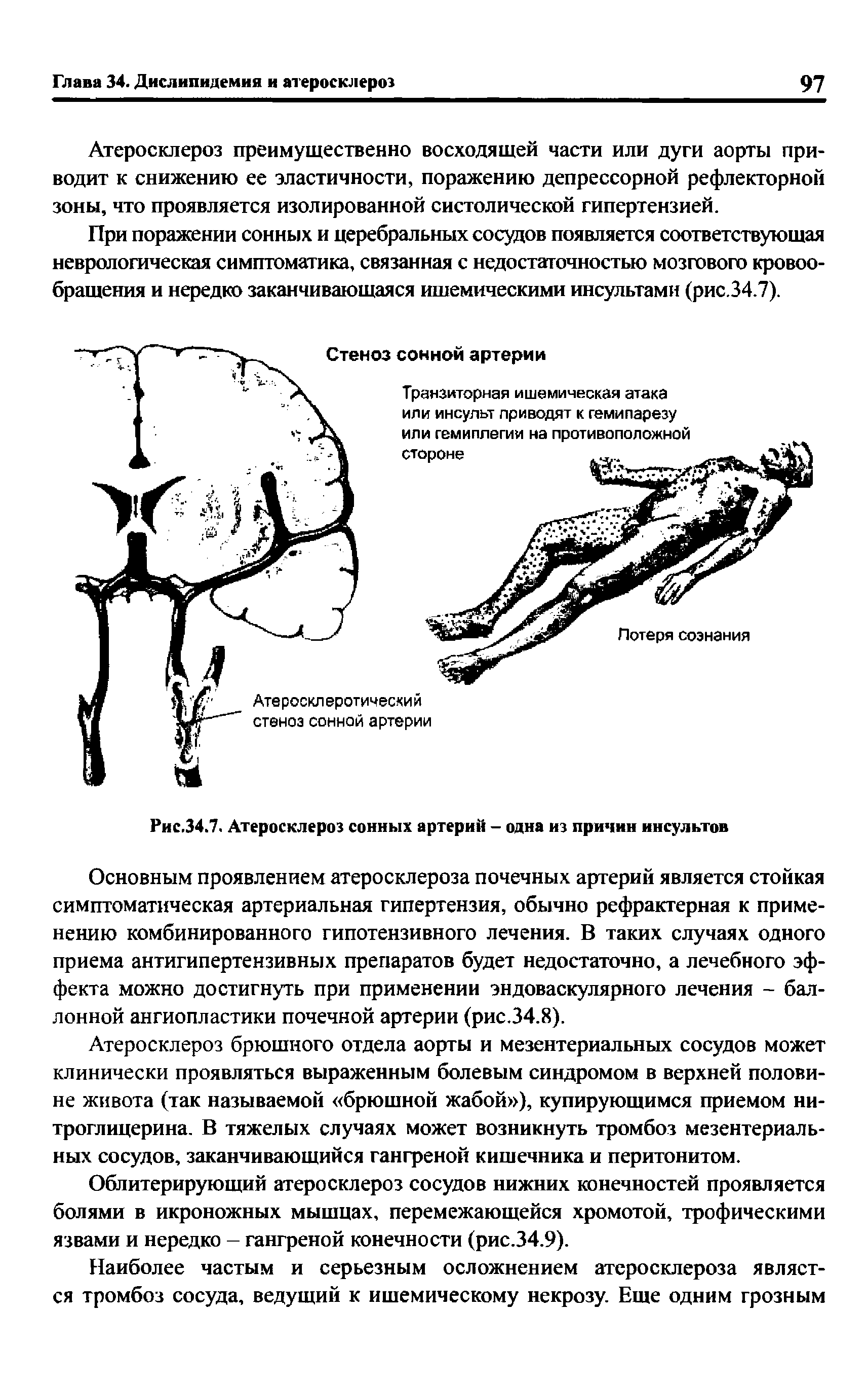 Рис.34.7. Атеросклероз сонных артерий - одна из причин инсультов...