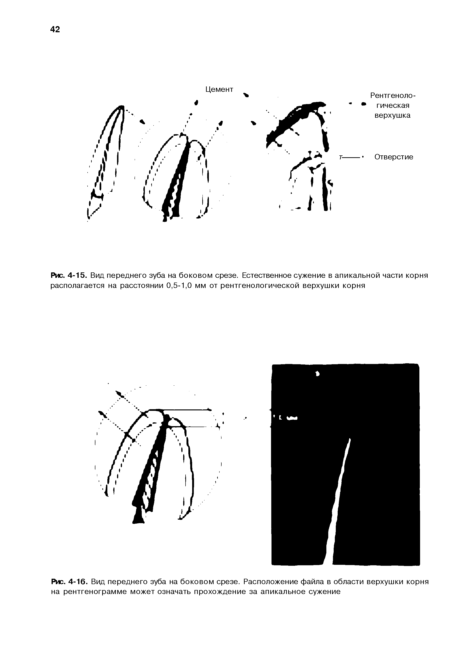 Рис. 4-15. Вид переднего зуба на боковом срезе. Естественное сужение в апикальной части корня располагается на расстоянии 0,5-1,0 мм от рентгенологической верхушки корня...