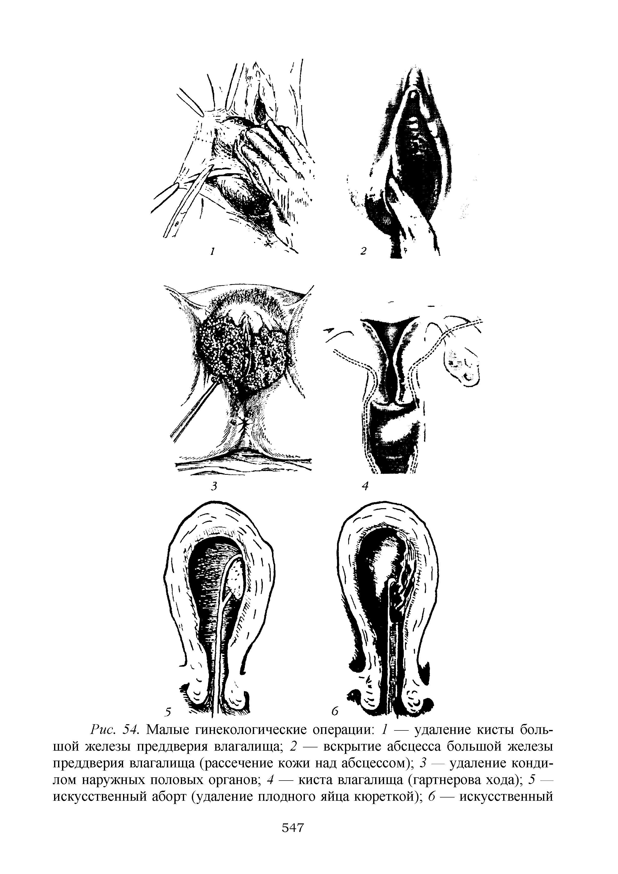 Рис. 54. Малые гинекологические операции 1 — удаление кисты большой железы преддверия влагалища 2 — вскрытие абсцесса большой железы преддверия влагалища (рассечение кожи над абсцессом) 3 — удаление кондилом наружных половых органов 4 — киста влагалища (гартнерова хода) 5 — искусственный аборт (удаление плодного яйца кюреткой) 6 — искусственный...