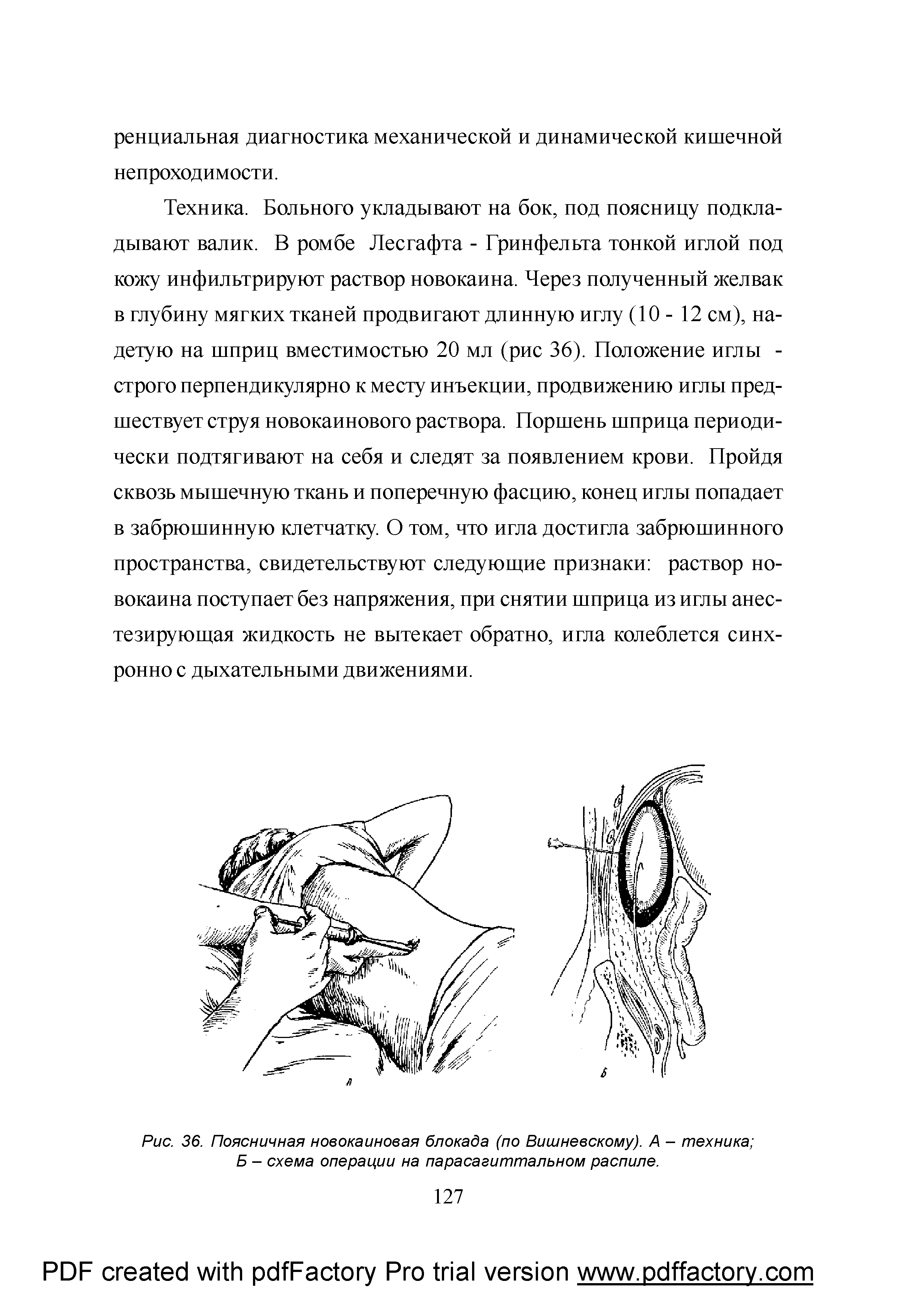 Рис. 36. Поясничная новокаиновая блокада (по Вишневскому). А - техника Б - схема операции на парасагиттальном распиле.
