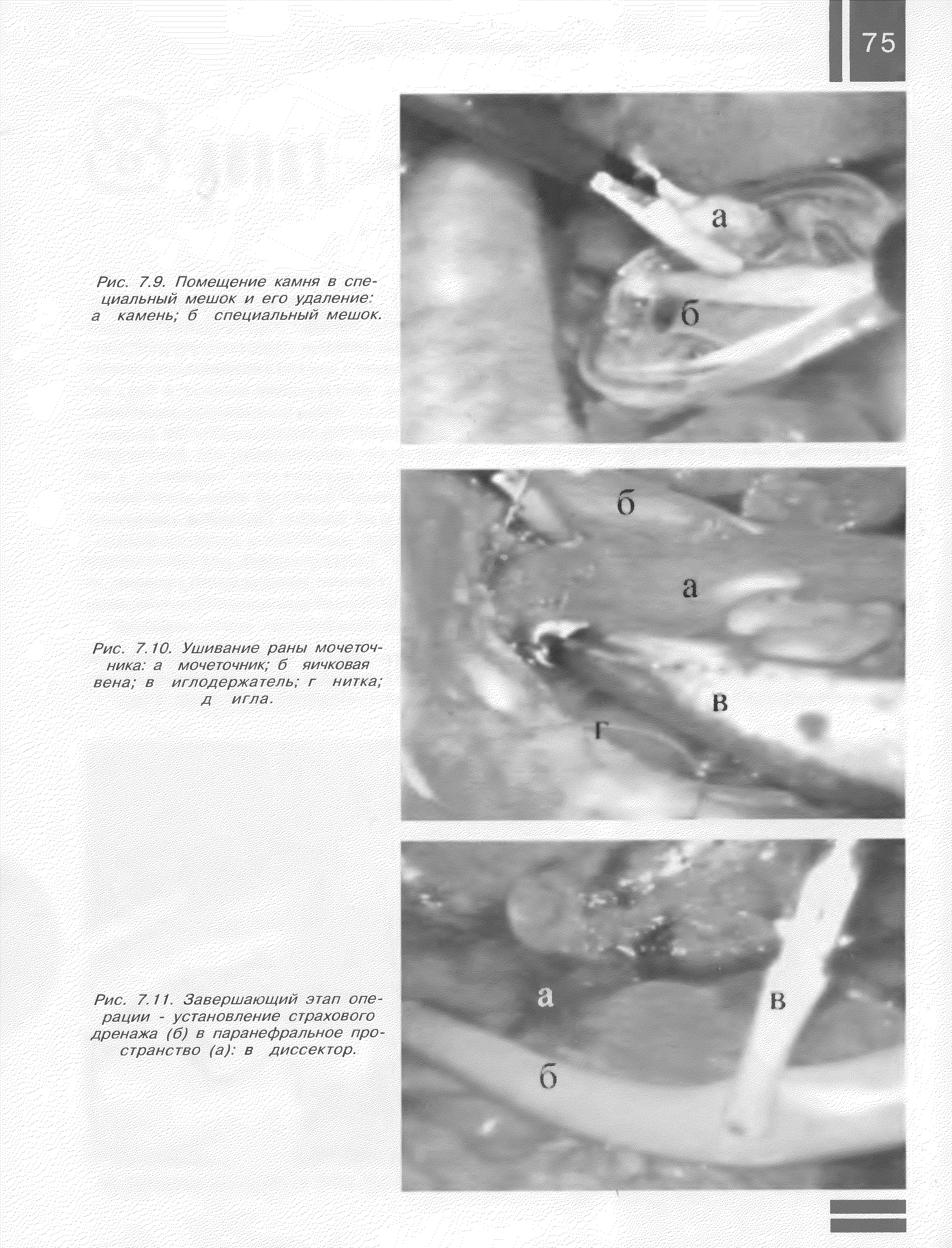 Рис. 7.10. Ушивание раны мочеточника а мочеточник б яичковая вена в иглодержатель г нитка, д игла.