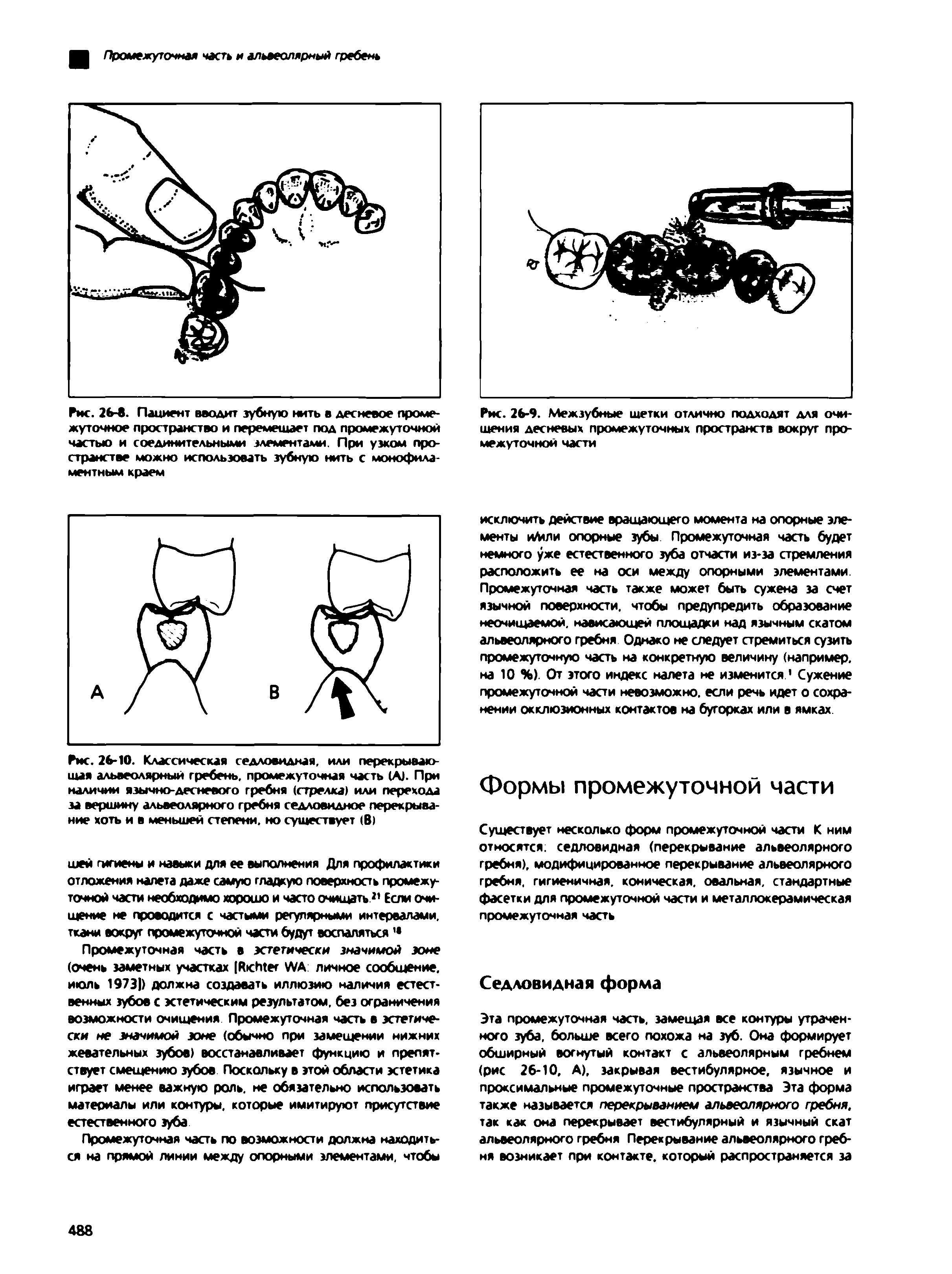 Рис. 26-10. Классическая седловидная, или перекрывающая альвеолярный гребень, промежуточная часть (А). При наличии язычно-десневого гребня (стрелка) или перехода за вершину альвеолярного гребня седловидное перекрывание хоть и в меньшей степени, но существует (В)...