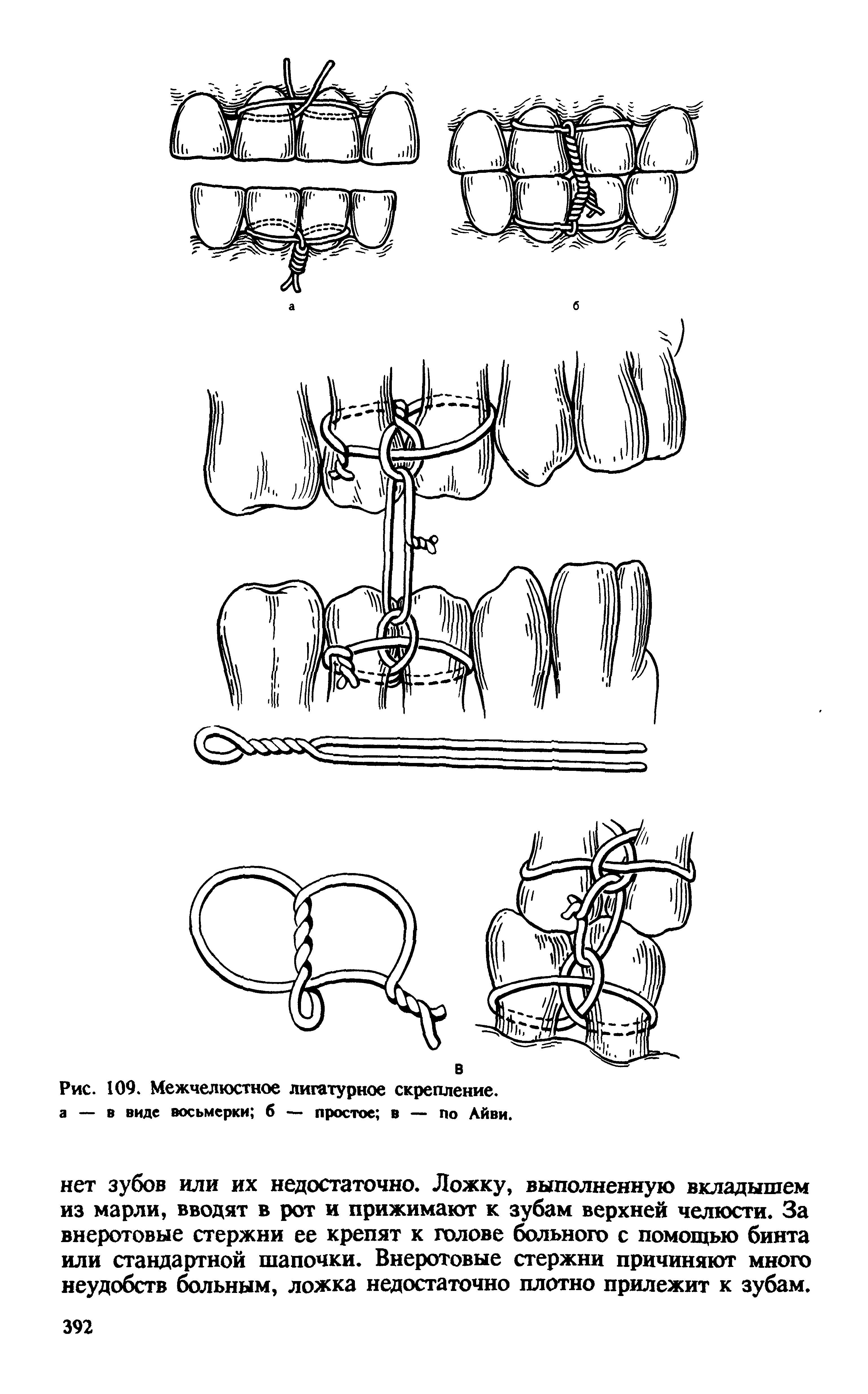 Рис. 109. Межчелюстное лигатурное скрепление, а — в виде восьмерки б — простое в — по Айви.