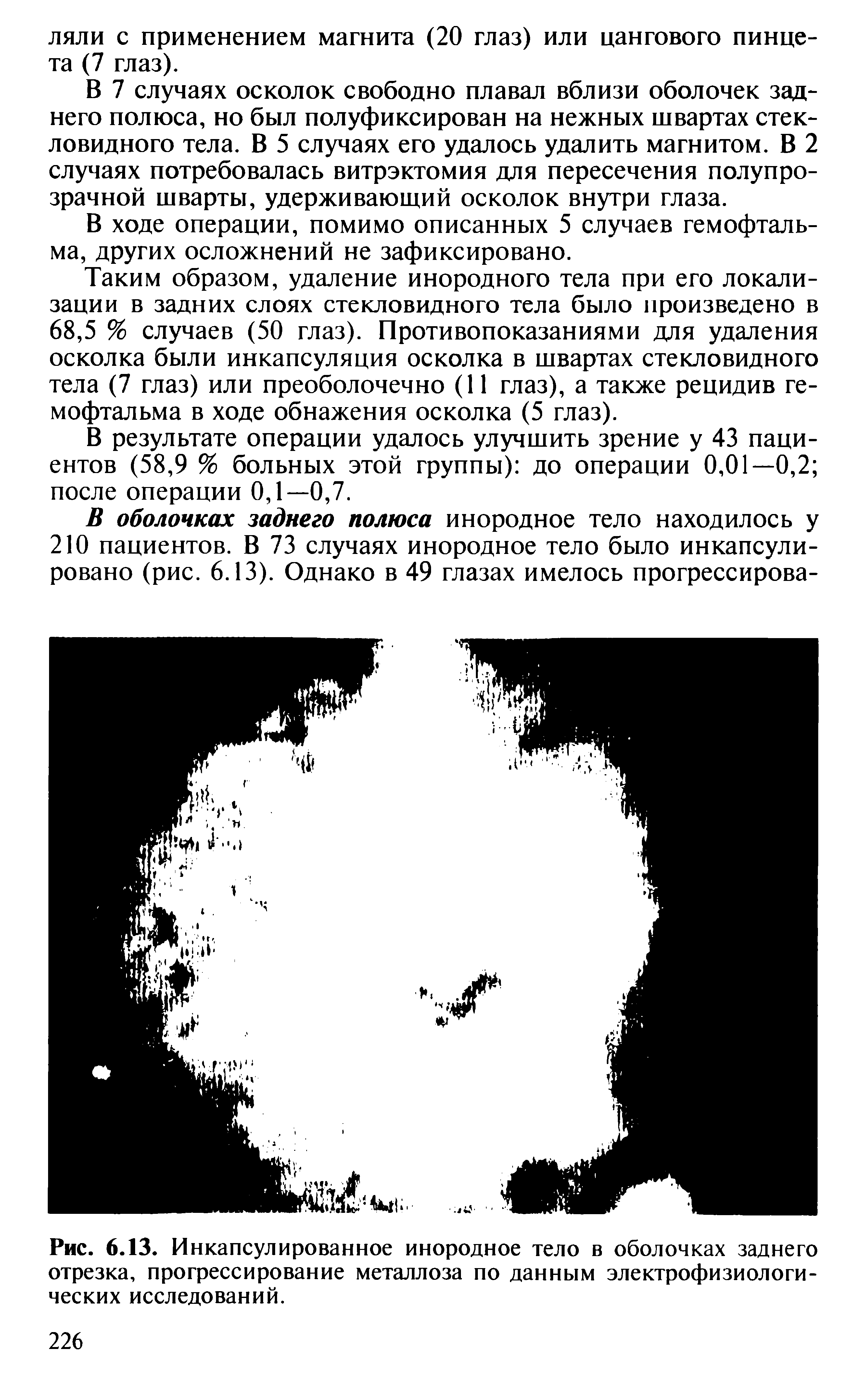 Рис. 6.13. Инкапсулированное инородное тело в оболочках заднего отрезка, прогрессирование металлоза по данным электрофизиологических исследований.