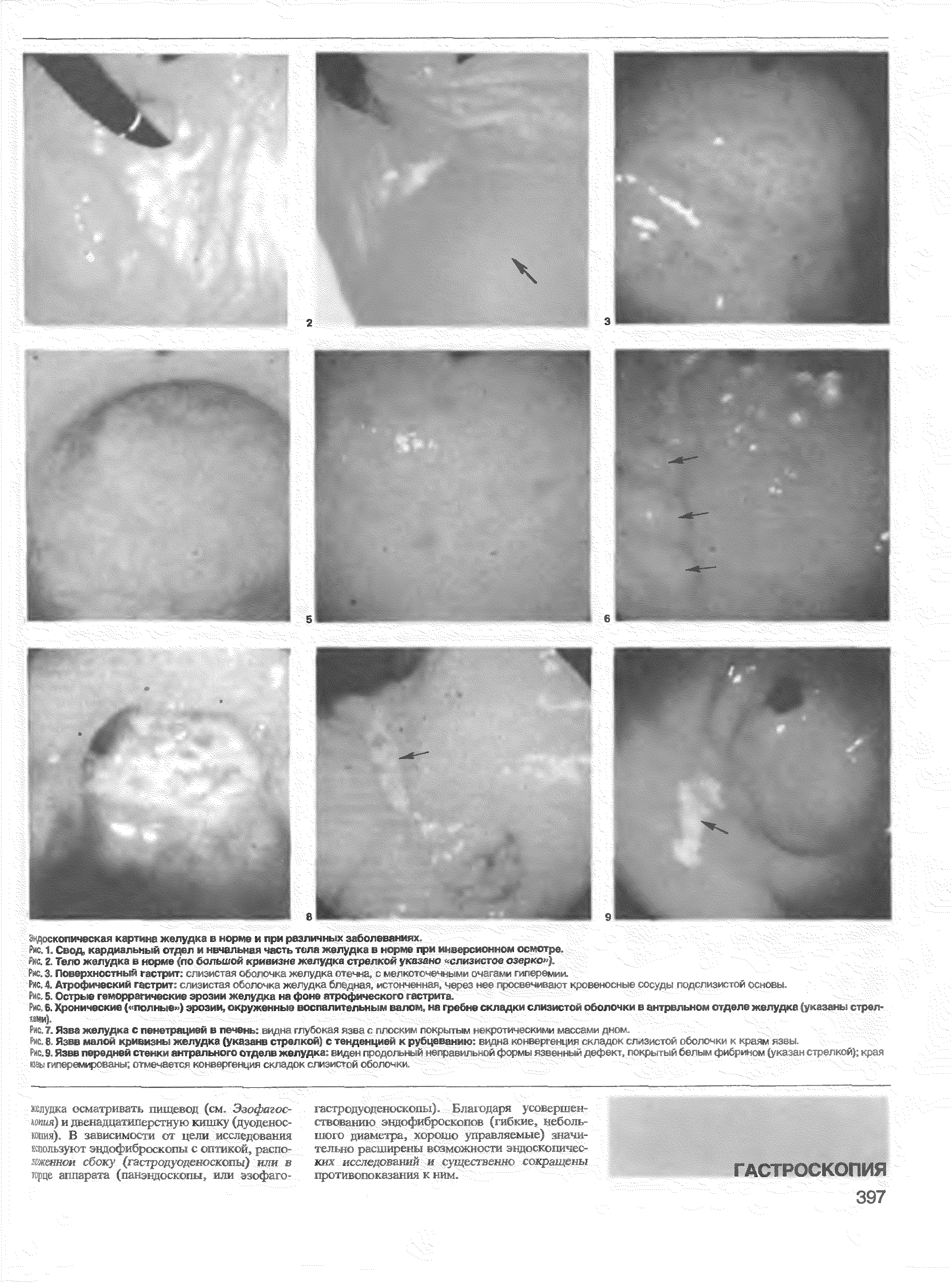 Рис. 9. Язвв передней стенки антрального отделе желудка виден г 1 < ч р 1 < эфект, покрытый белым фибрином (указан стрелкой) края...