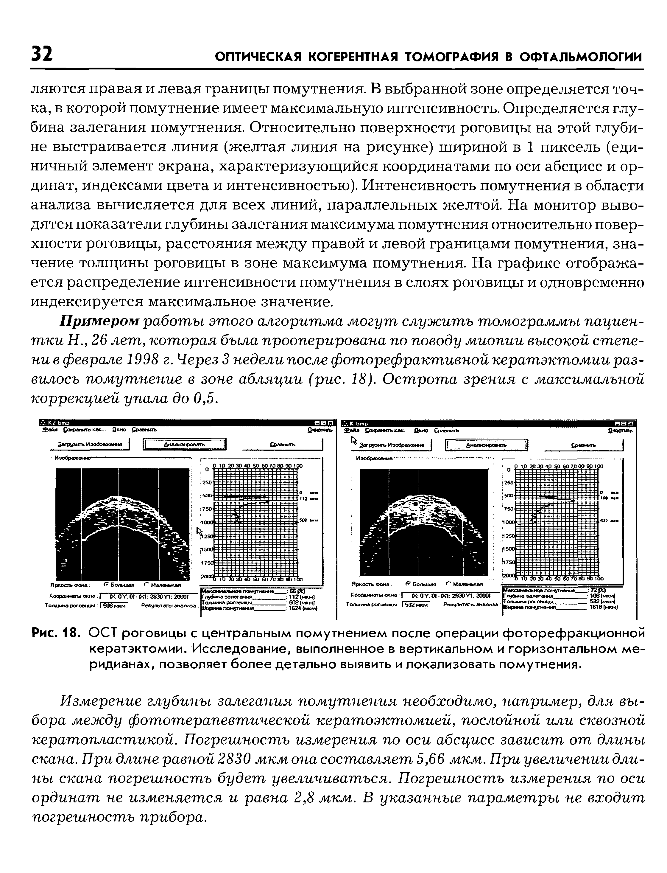 Рис. 18. ОСТ роговицы с центральным помутнением после операции фоторефракционной кератэктомии. Исследование, выполненное в вертикальном и горизонтальном меридианах, позволяет более детально выявить и локализовать помутнения.