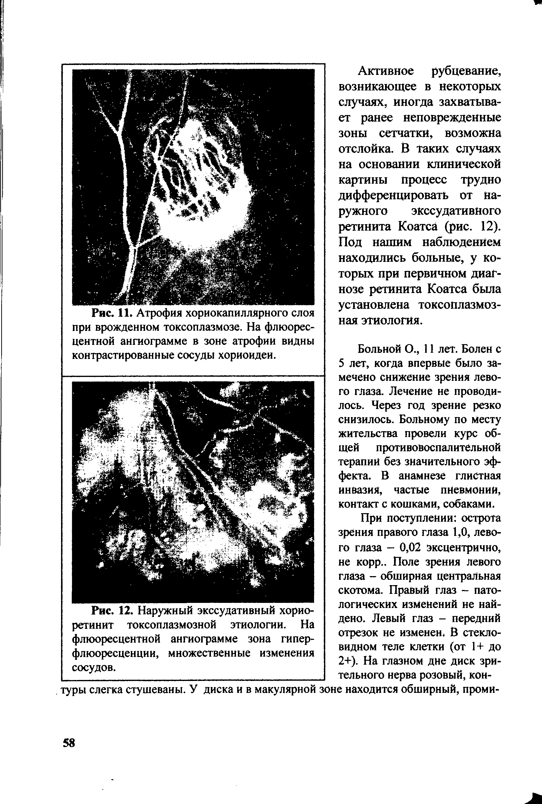 Рис. 12. Наружный экссудативный хорио-ретинит токсоплазмозной этиологии. На флюоресцентной ангиограмме зона гиперфлюоресценции, множественные изменения сосудов.