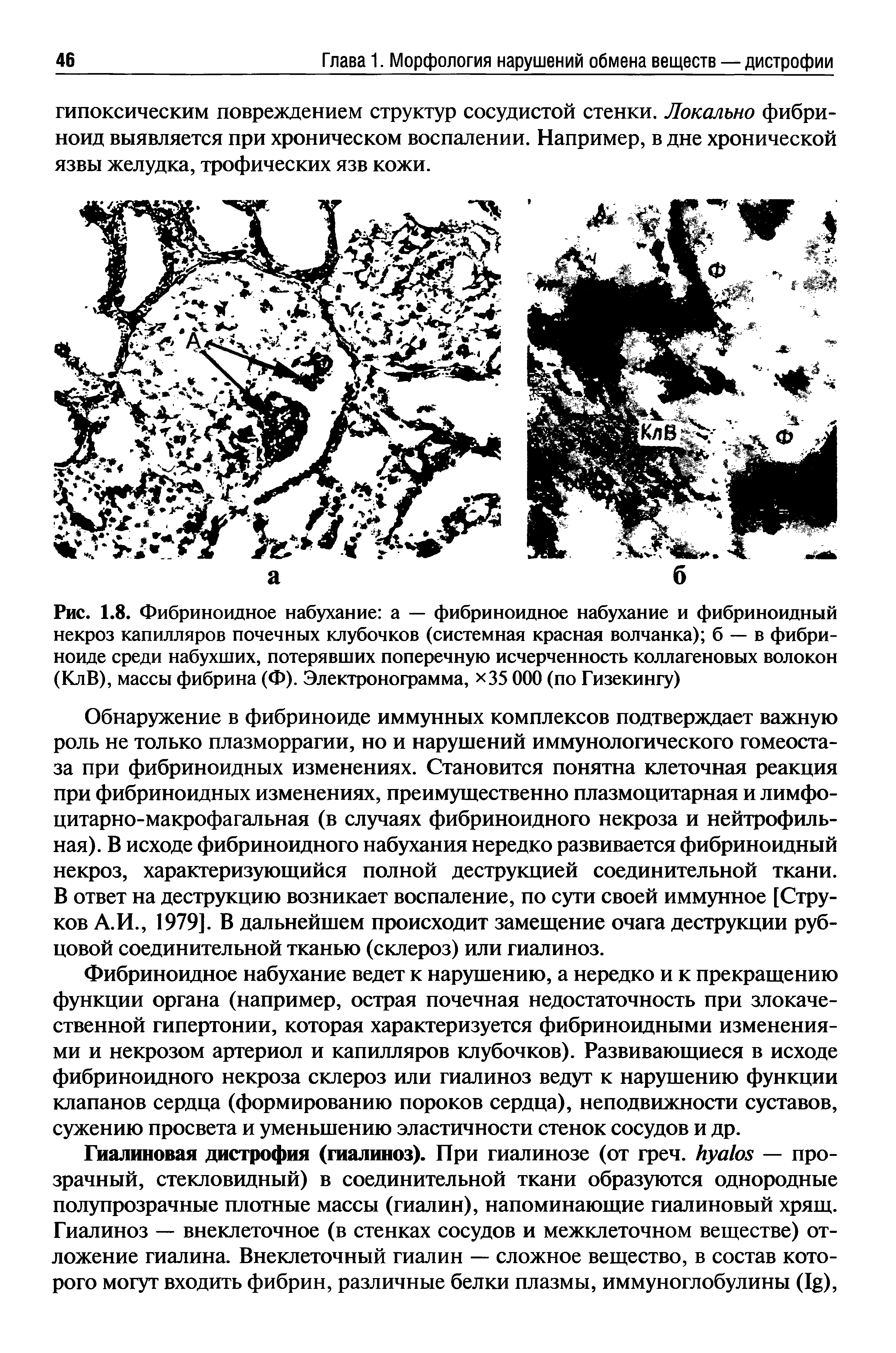 Рис. 1.8. Фибриноидное набухание а — фибриноидное набухание и фибриноидный некроз капилляров почечных клубочков (системная красная волчанка) б — в фибриноиде среди набухших, потерявших поперечную исчерченность коллагеновых волокон (КлВ), массы фибрина (Ф). Электронограмма, 35 000 (по Гизекингу)...