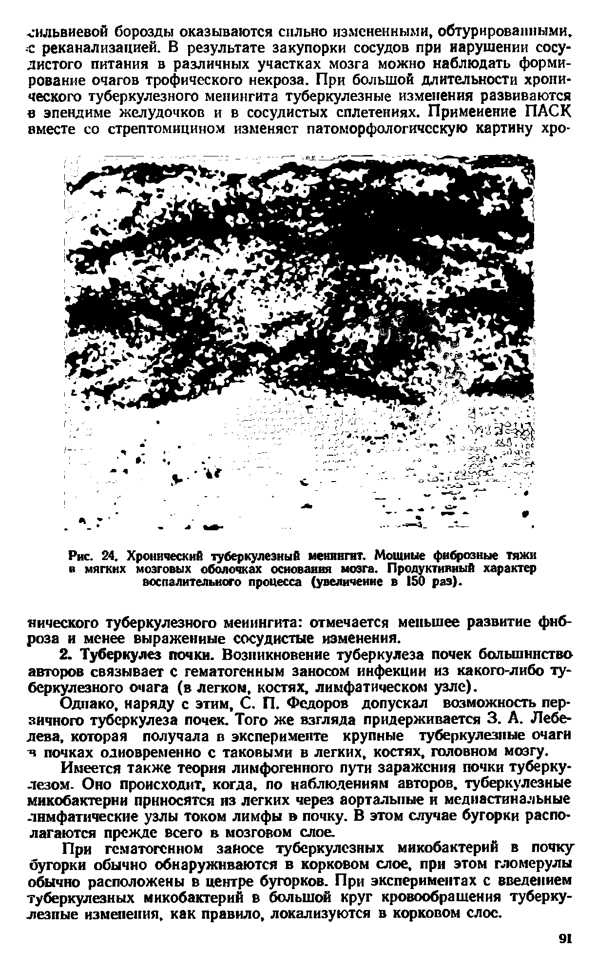 Рис. 24. Хронический туберкулезный менингит. Мощные фиброзные тяжи и мягких мозговых оболочках основания мозга. Продуктивный характер воспалительного процесса (увеличение в 150 раз).