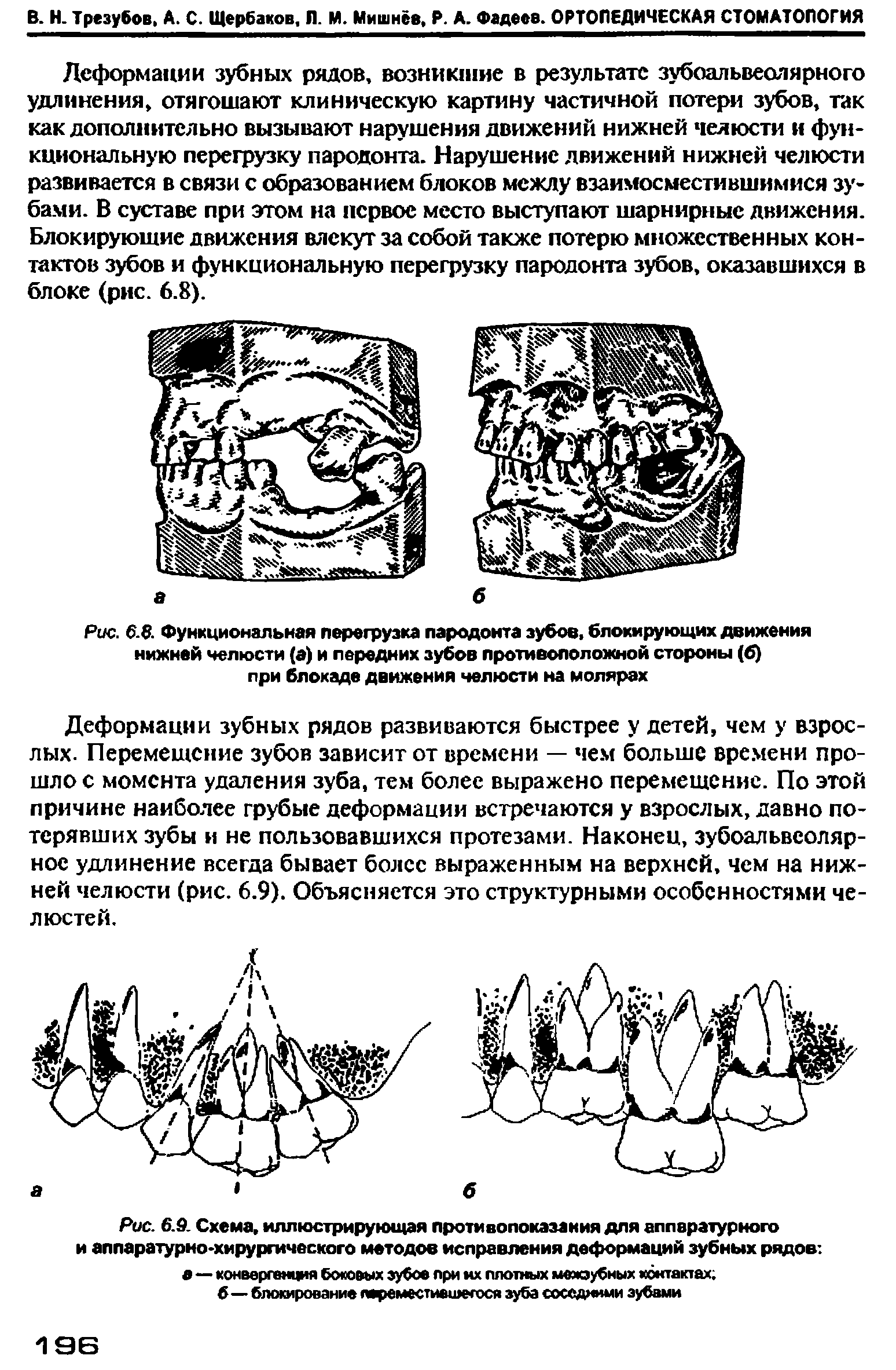 Рис. 6.9. Схема, иллюстрирующая противопоказания для аппаратурного и аппаратурно-хирургического методов исправления деформаций зубных радов а — конвергенция боковых зубов при их плотных межзубных контактах ...