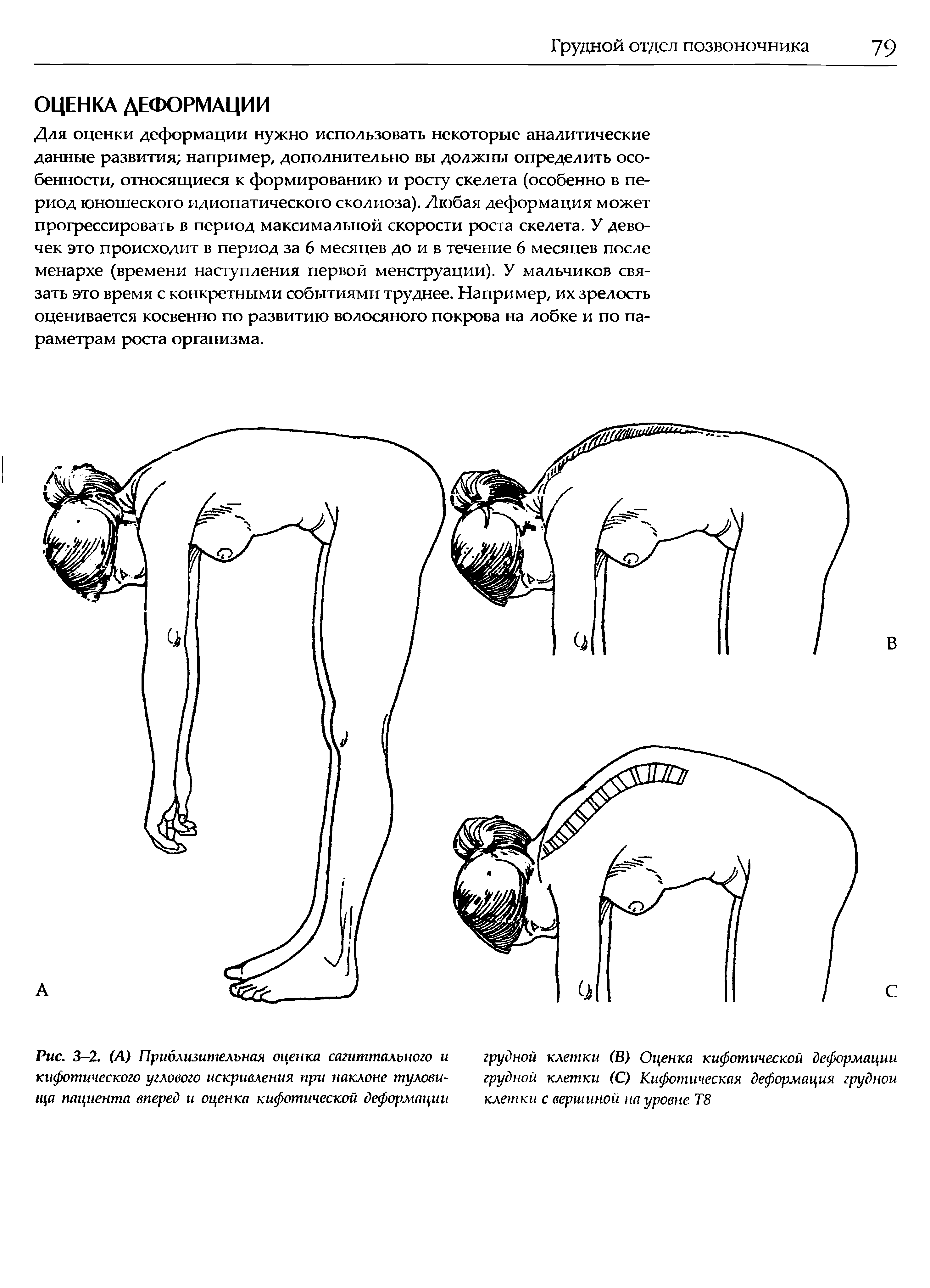 Рис. 3-2. (А) Приблизительная оценка сагиттального и кифотического углового искривления при наклоне туловища пациента вперед и оценка кифотической деформации...