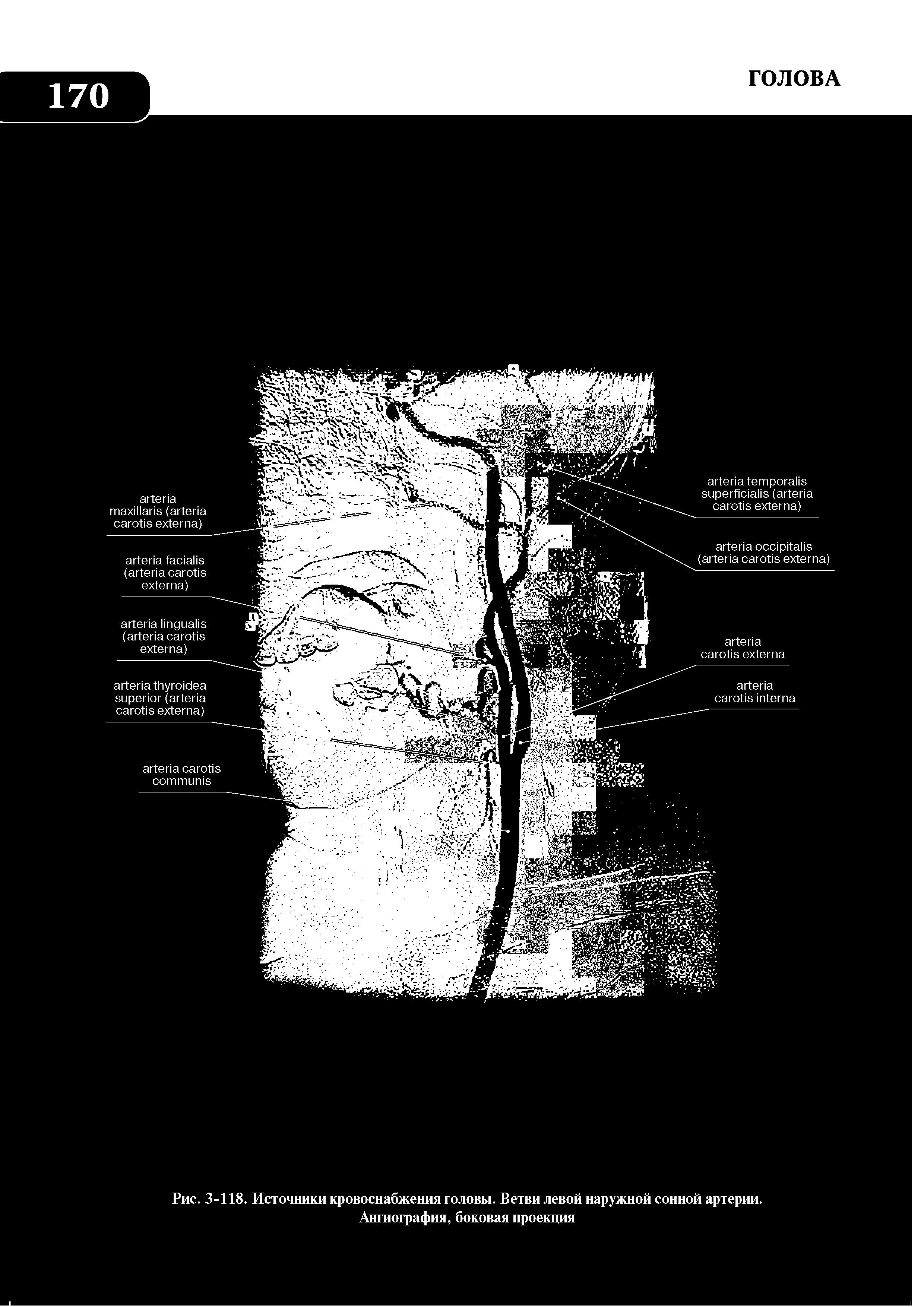 Рис. 3-118. Источники кровоснабжения головы. Ветви левой наружной сонной артерии. Ангиография, боковая проекция...