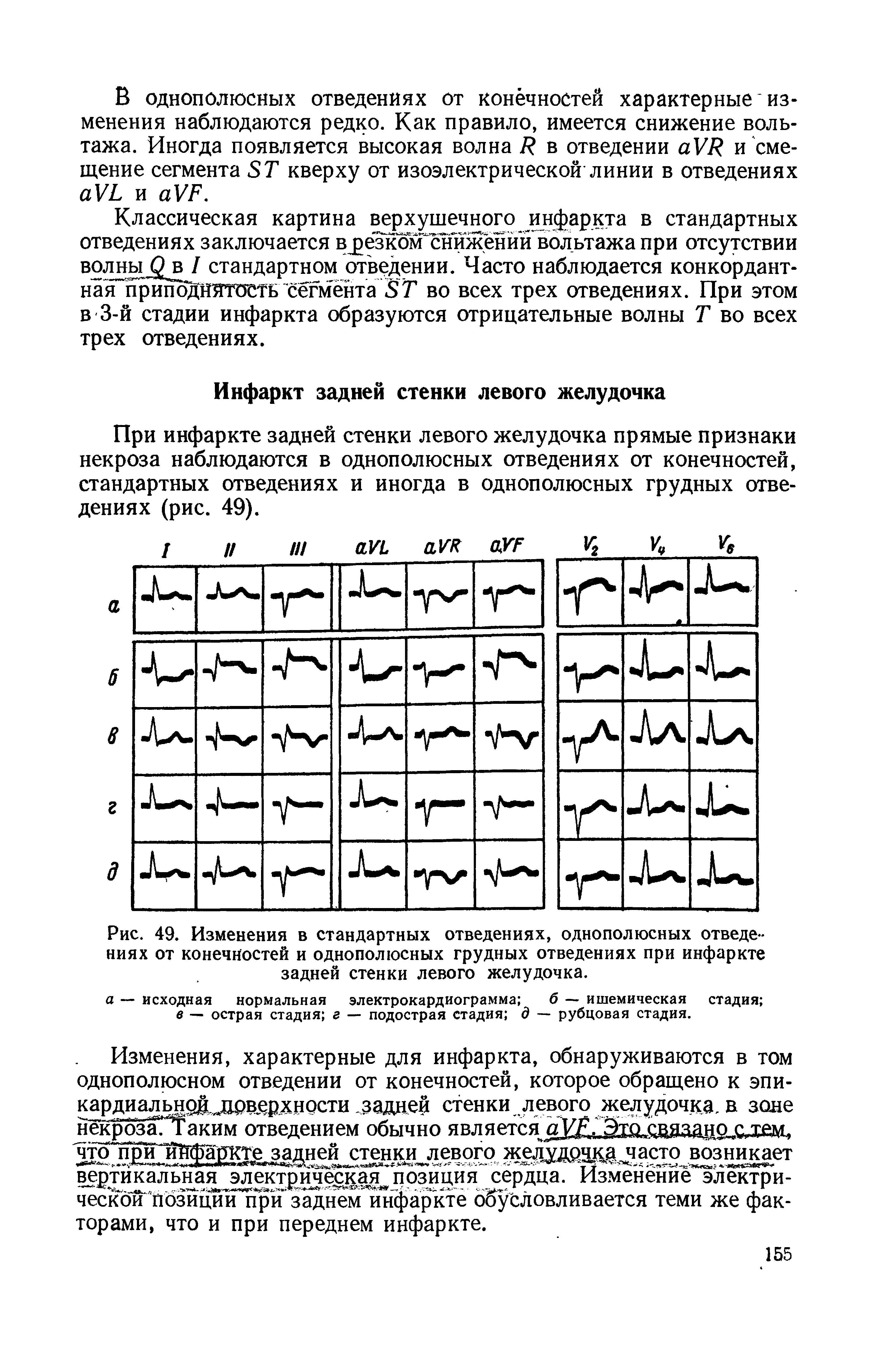 Рис. 49. Изменения в стандартных отведениях, однополюсных отведениях от конечностей и однополюсных грудных отведениях при инфаркте задней стенки левого желудочка.