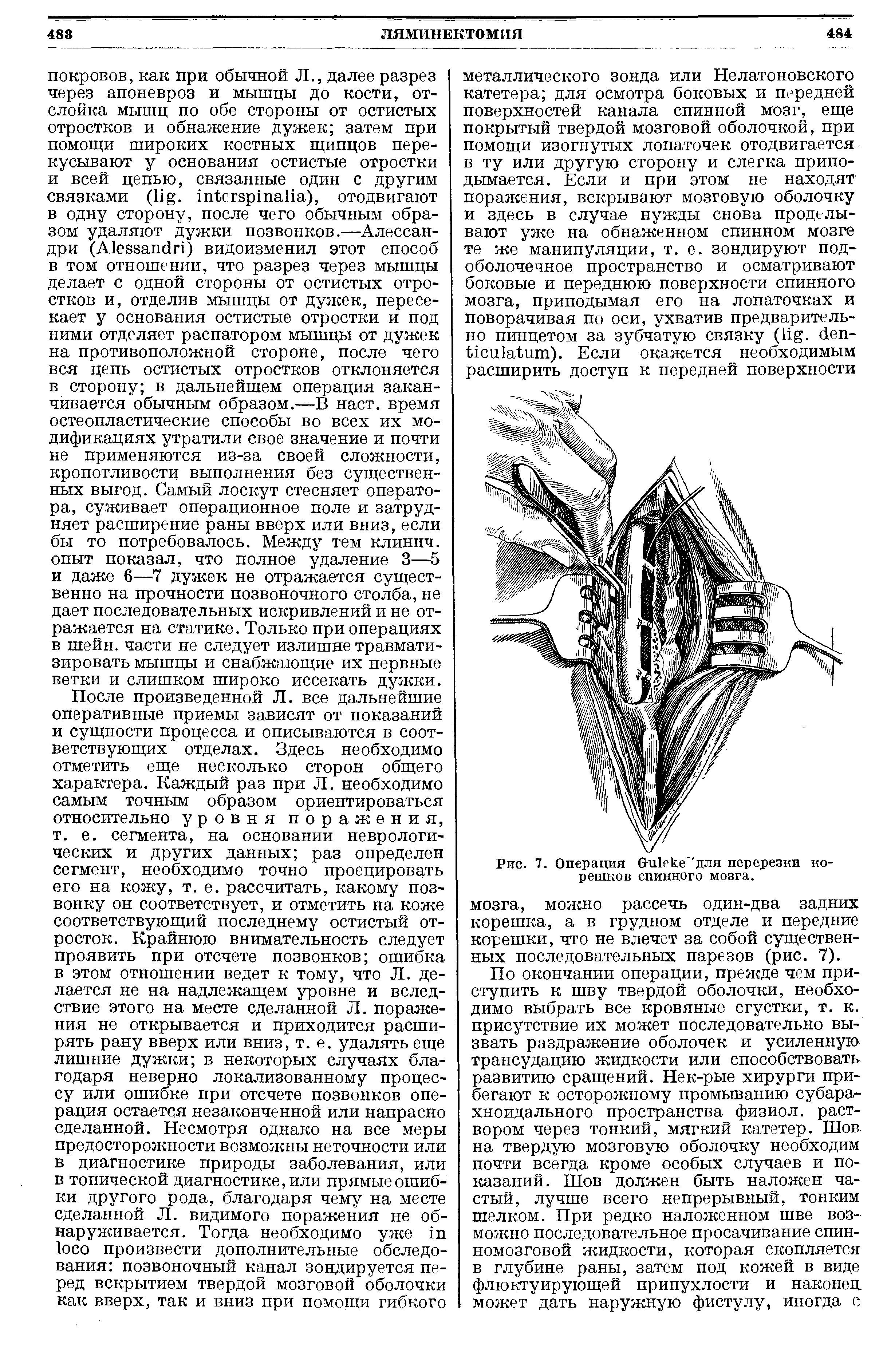 Рис. 7. Операция викке для перерезки корешков спинного мозга.