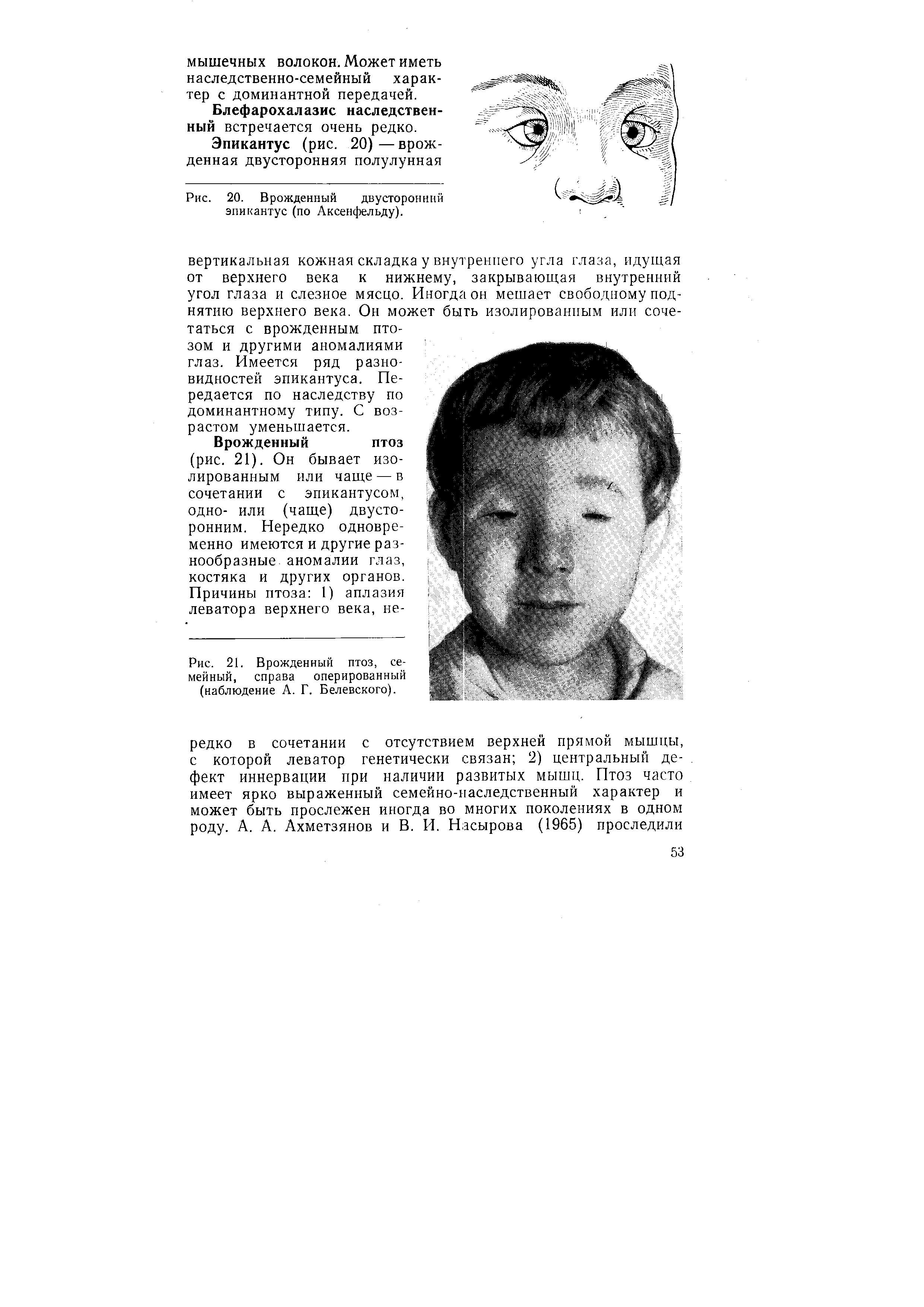 Рис. 21. Врожденный птоз, семейный, справа оперированный (наблюдение А. Г. Белевского).