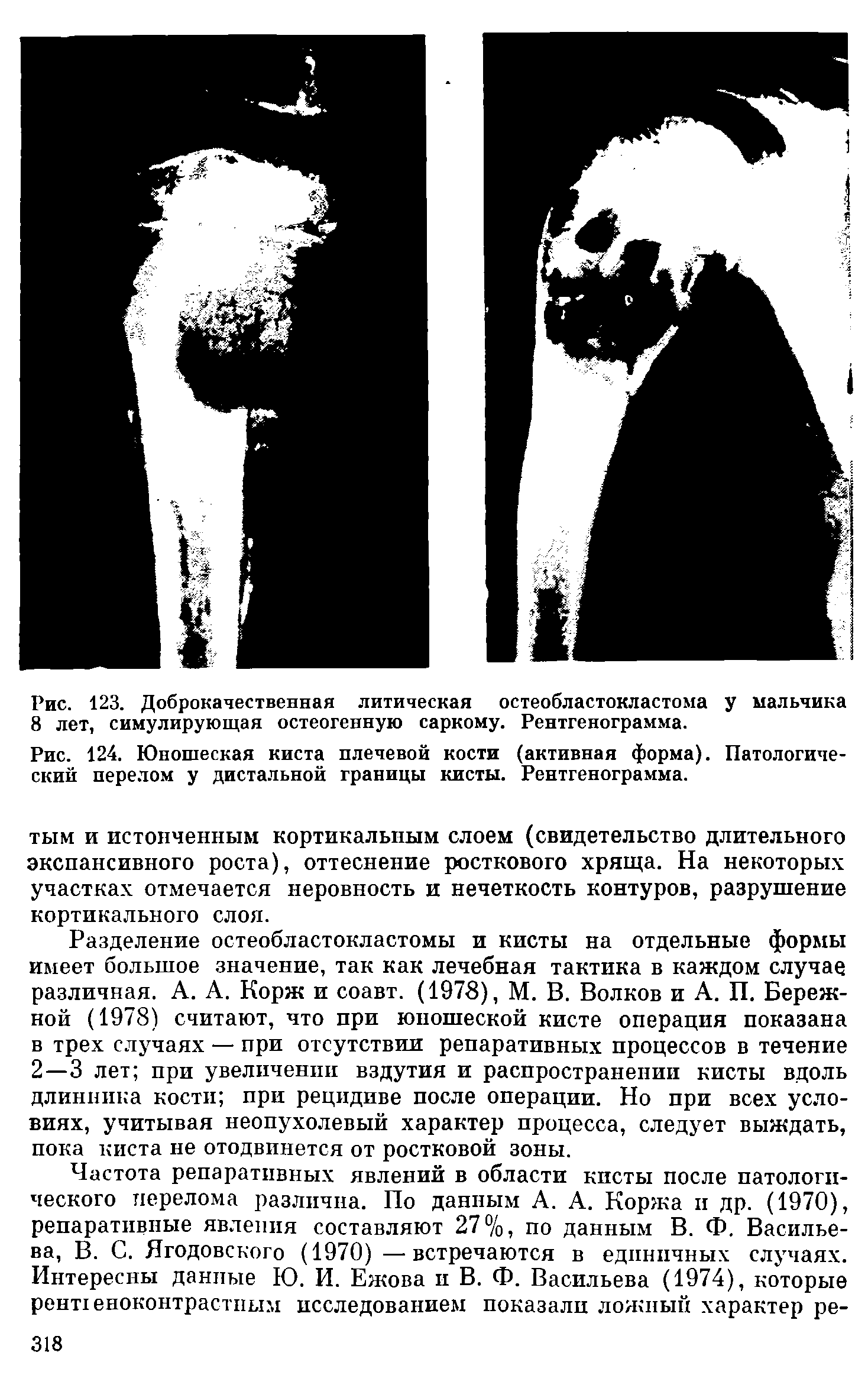 Рис. 124. Юношеская киста плечевой кости (активная форма). Патологический перелом у дистальной границы кисты. Рентгенограмма.