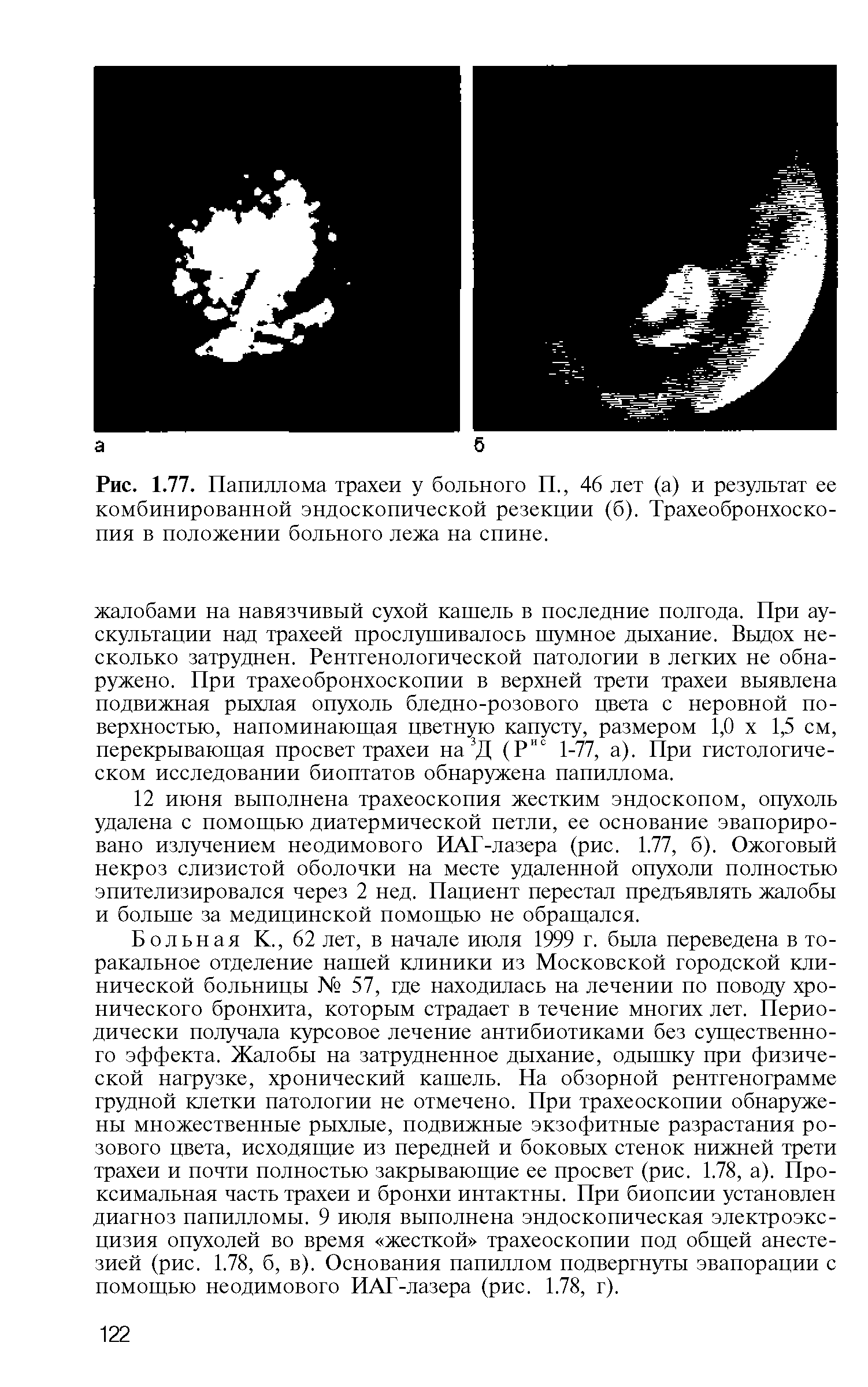 Рис. 1.77. Папиллома трахеи у больного П., 46 лет (а) и результат ее комбинированной эндоскопической резекции (б). Трахеобронхоско-пия в положении больного лежа на спине.