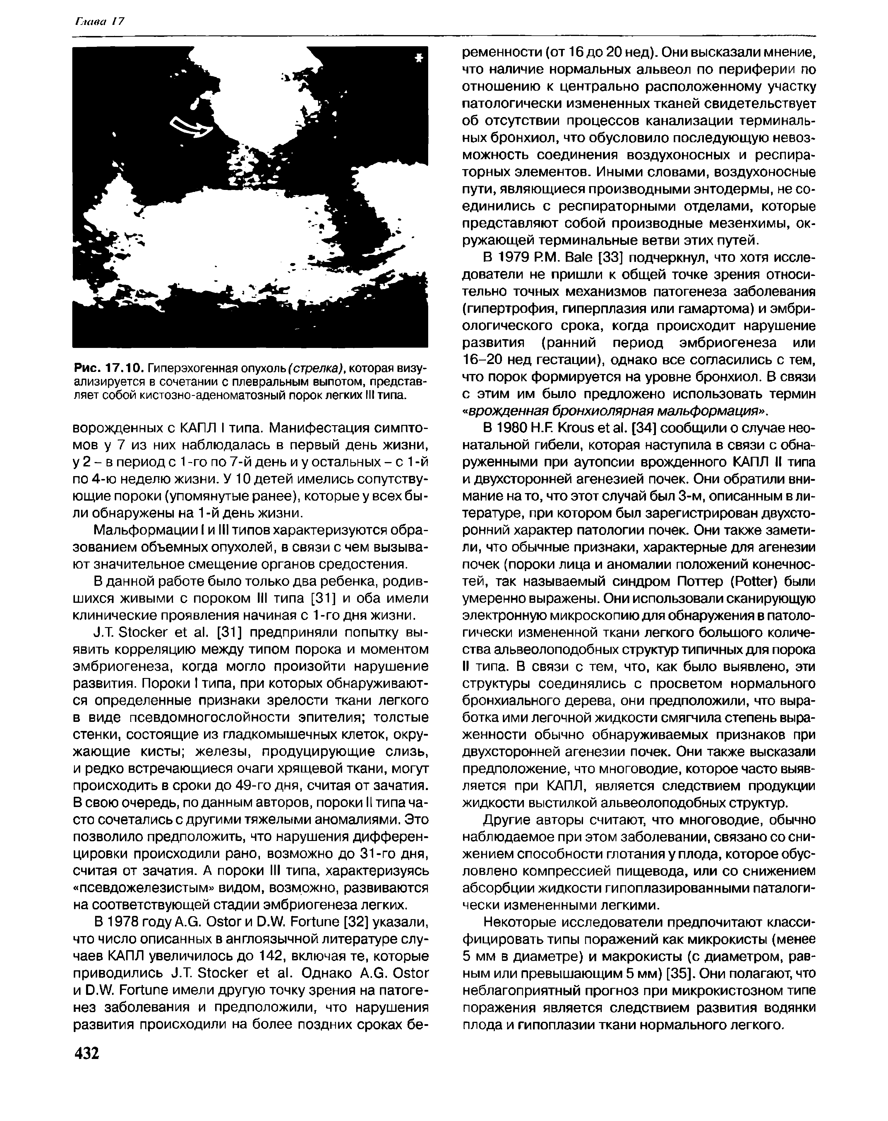 Рис. 17.10. Гиперэхогенная опухоль (стрелка), которая визуализируется в сочетании с плевральным выпотом, представляет собой кистозно-аденоматозный порок легких III типа.