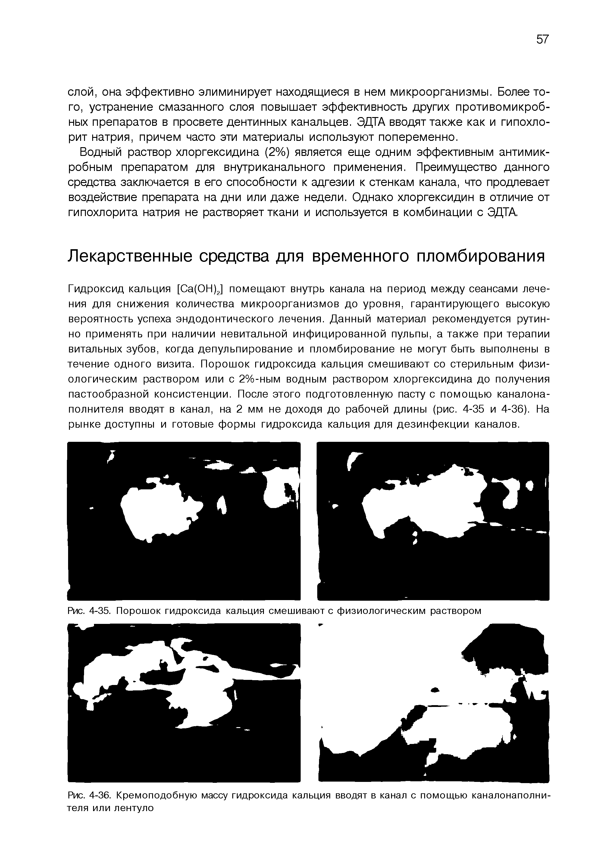 Рис. 4-36. Кремоподобную массу гидроксида кальция вводят в канал с помощью каналонаполни-теля или лентуло...