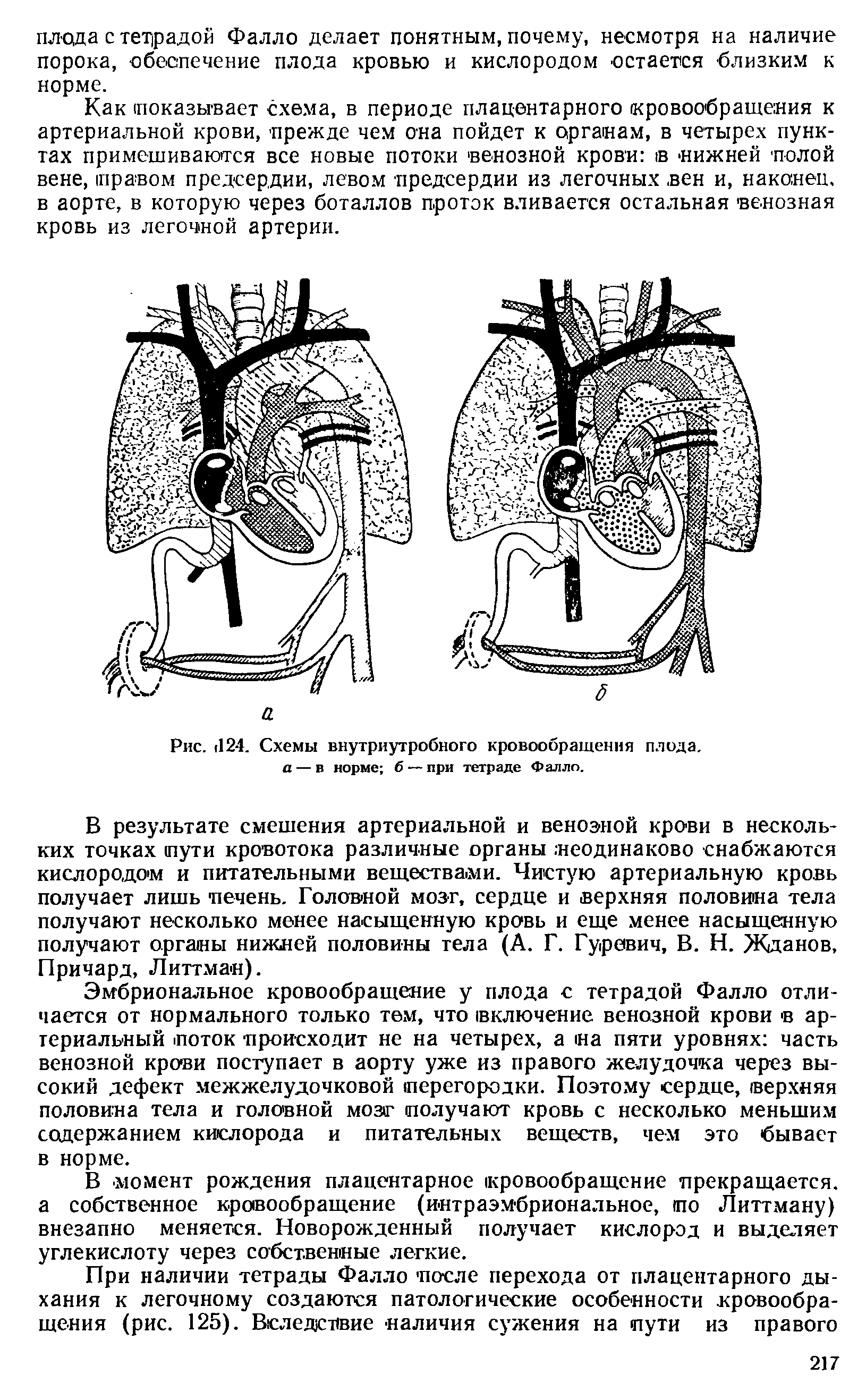 Рис. <124. Схемы внутриутробного кровообращения плода. а — в норме б — при тетраде Фалло.