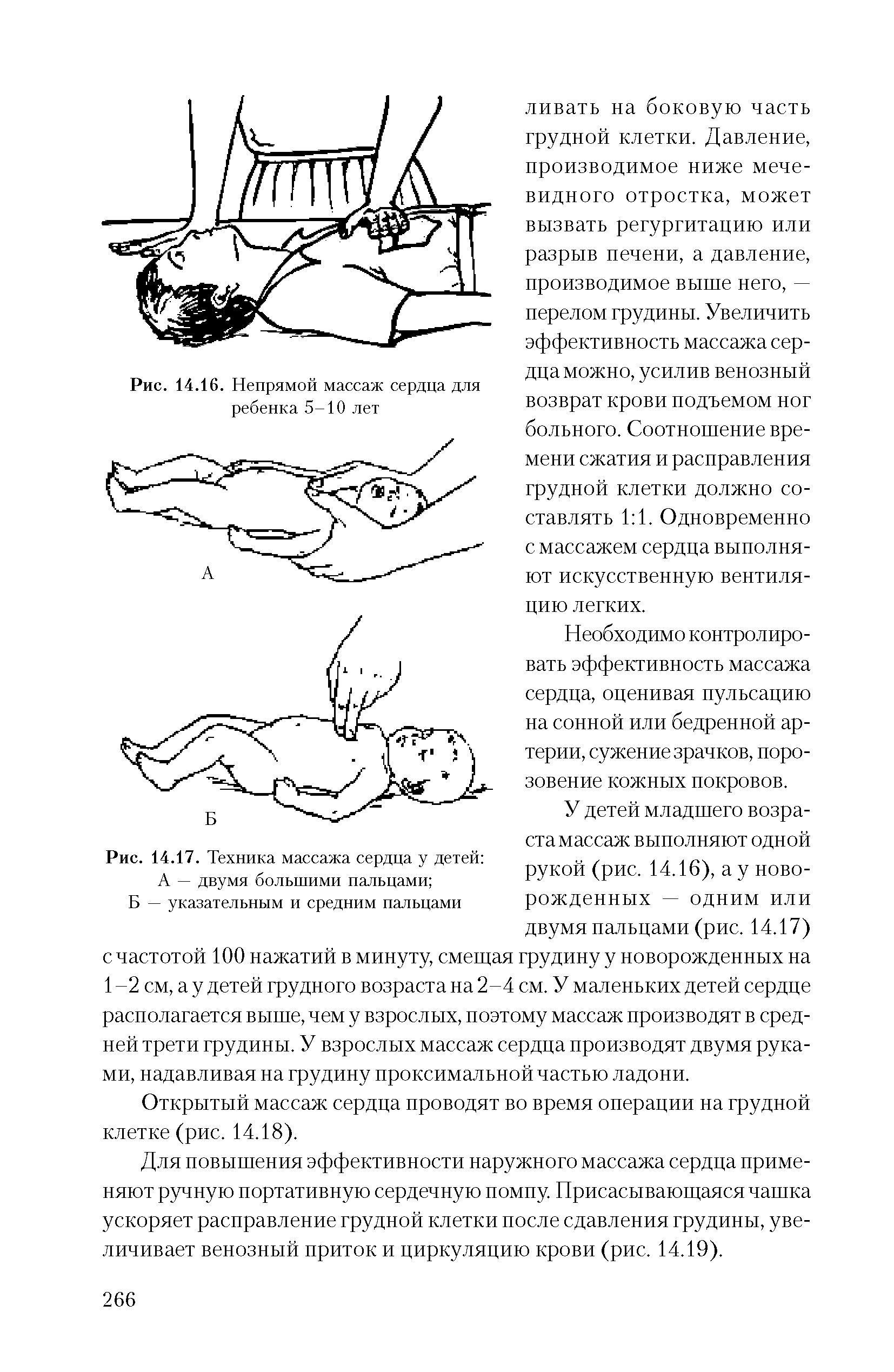 Рис. 14.17. Техника массажа сердца у детей А — двумя большими пальцами ...