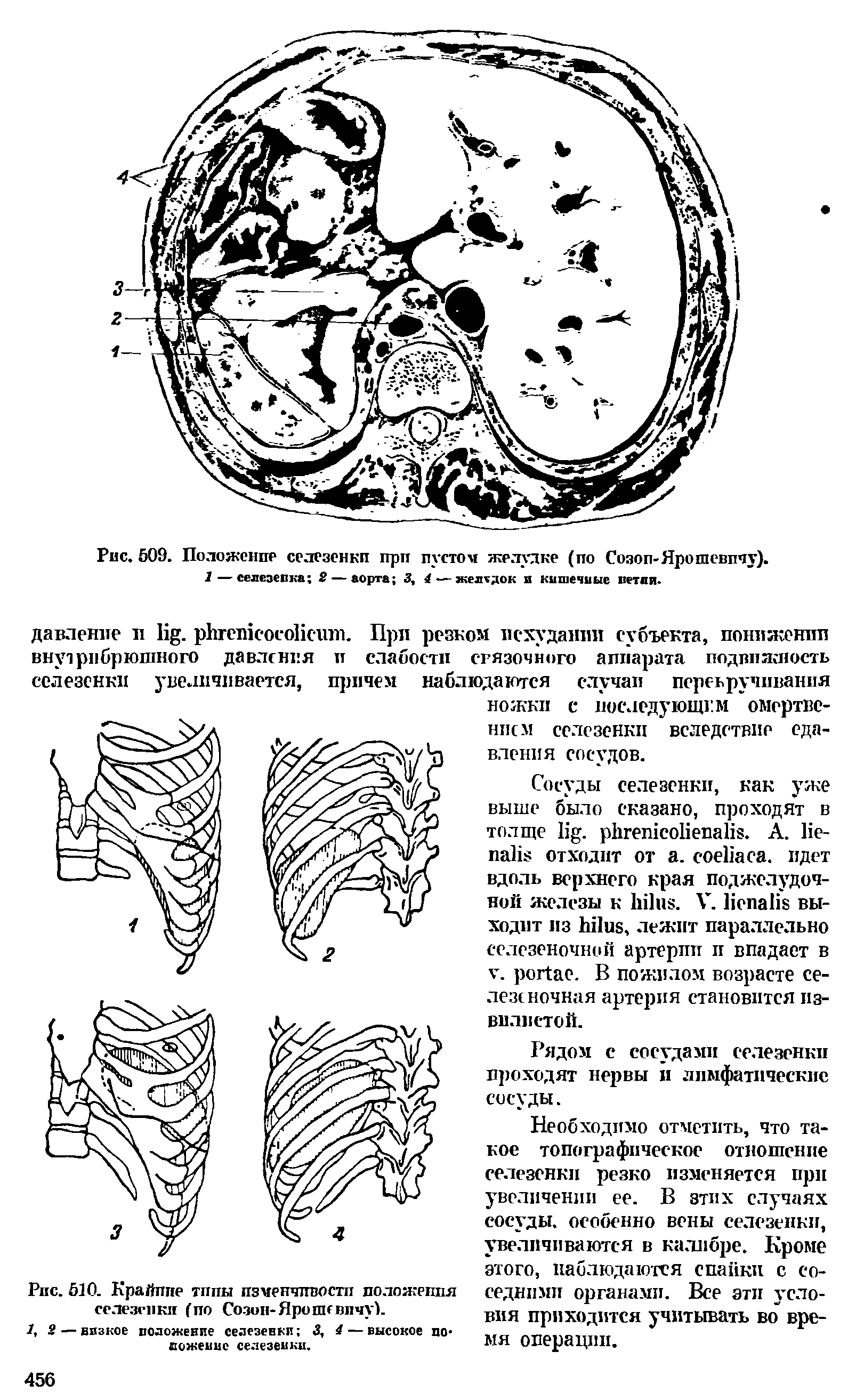 Рис. 510. Крайппе типы изменчивости положеппя селезенки (по Созоп-Яропивпчук...
