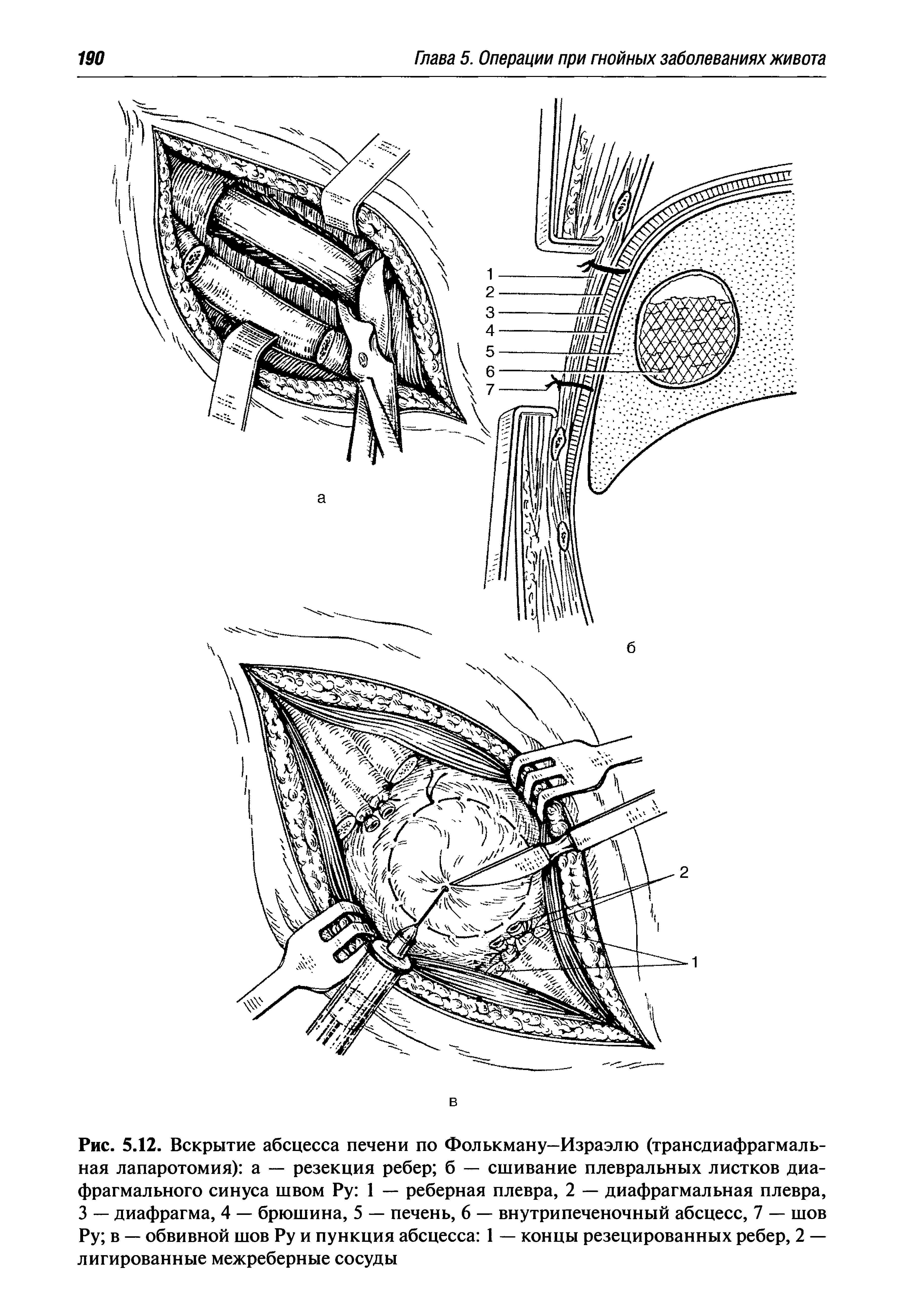 Рис. 5.12. Вскрытие абсцесса печени по Фолькману—Израэлю (трансдиафрагмальная лапаротомия) а — резекция ребер б — сшивание плевральных листков диафрагмального синуса швом Ру 1 — реберная плевра, 2 — диафрагмальная плевра, 3 — диафрагма, 4 — брюшина, 5 — печень, 6 — внутрипеченочный абсцесс, 7 — шов Ру в — обвивной шов Ру и пункция абсцесса 1 — концы резецированных ребер, 2 — лигированные межреберные сосуды...