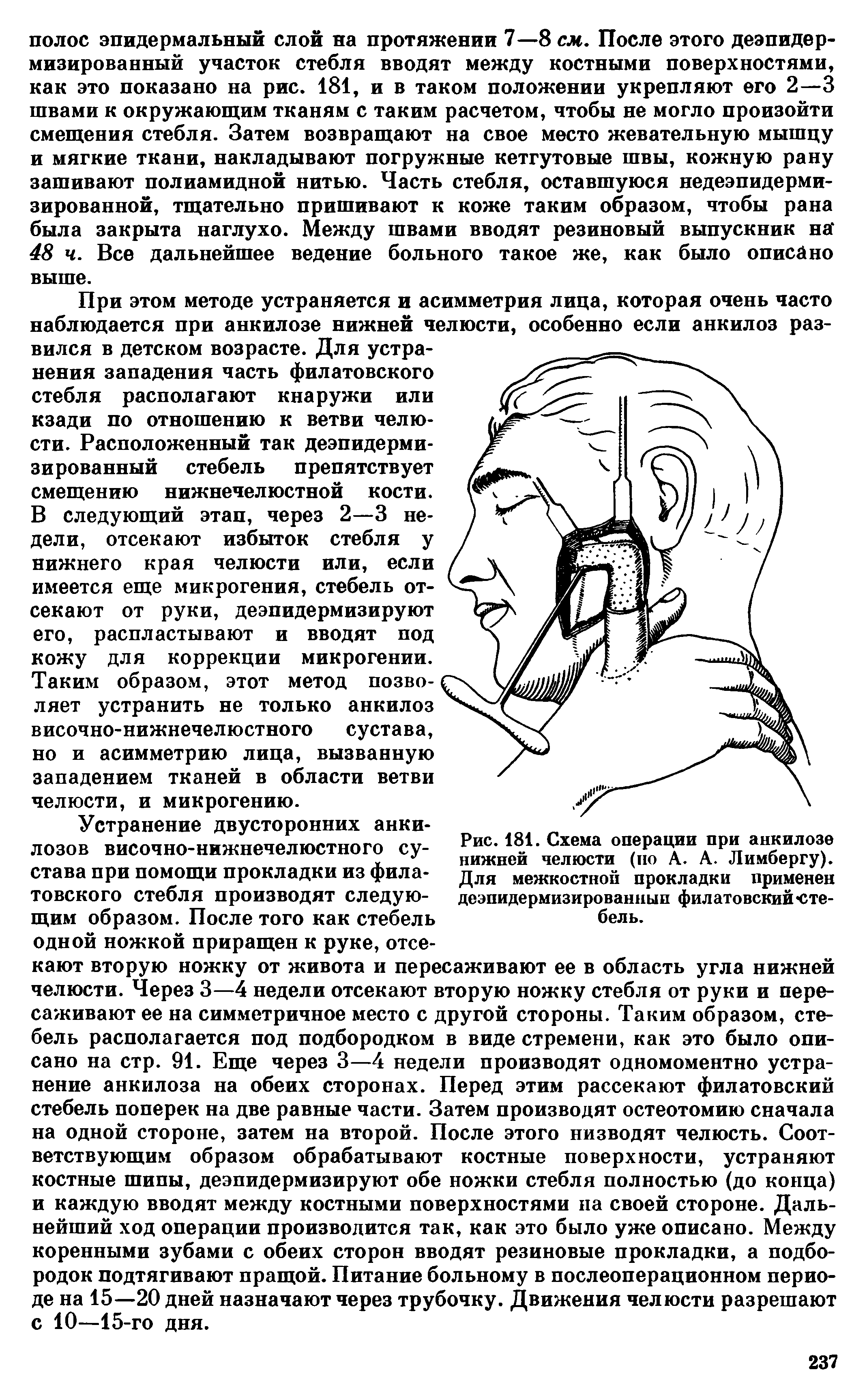 Рис. 181. Схема операции при анкилозе нижней челюсти (по А. А. Лимбергу). Для межкостной прокладки применен деэпидермизированныи филатовский стебель.