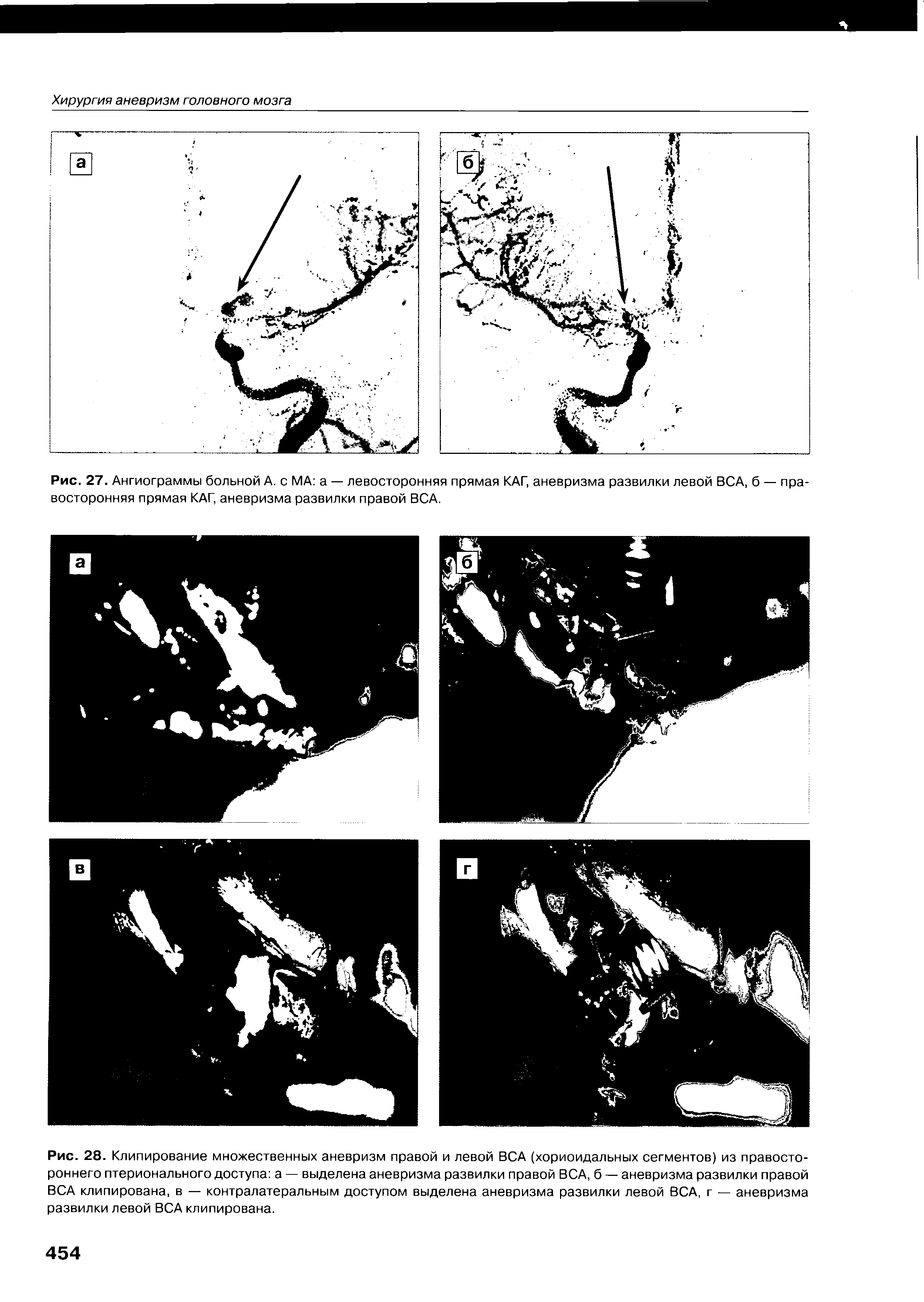 Рис. 28. Клипирование множественных аневризм правой и левой ВСА (хориоидальных сегментов) из правостороннего птерионального доступа а — выделена аневризма развилки правой ВСА, б — аневризма развилки правой ВСА клипирована, в — контралатеральным доступом выделена аневризма развилки левой ВСА, г — аневризма развилки левой ВСА клипирована.